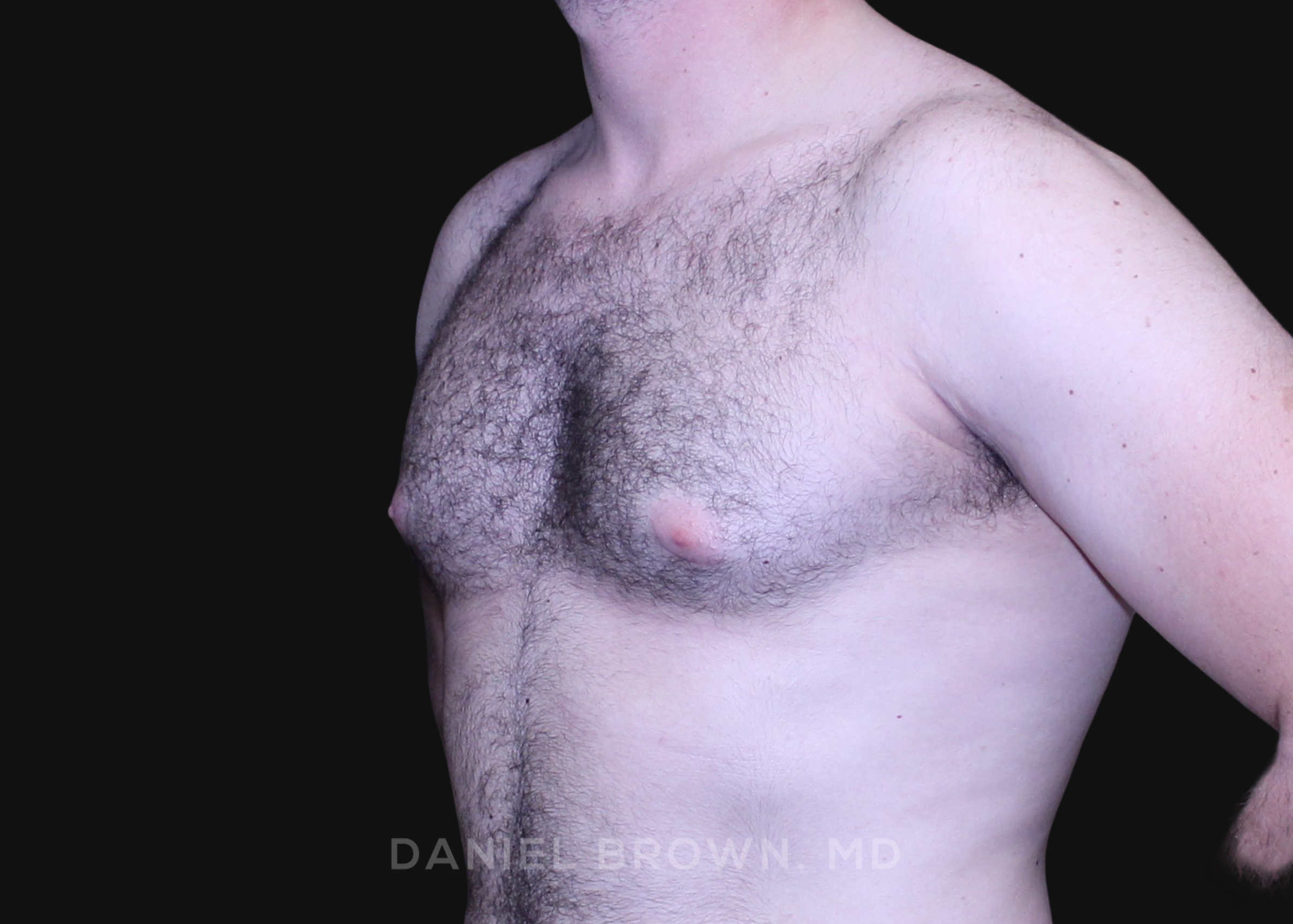 Male Breast Reduction Patient Photo - Case 2746 - before view-