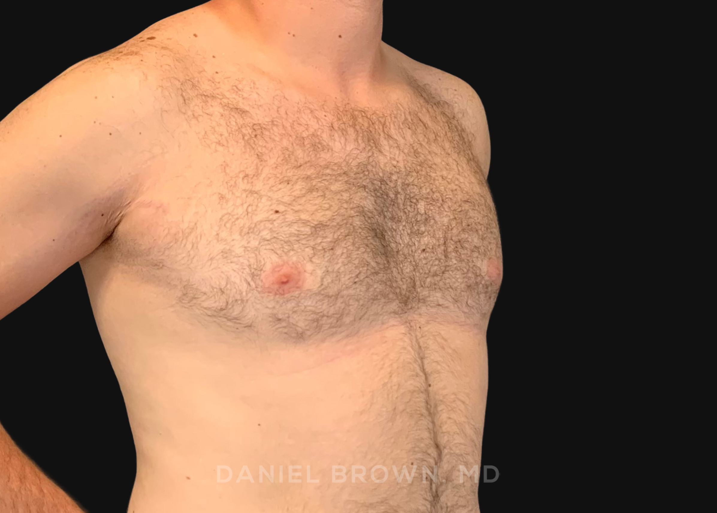 Male Breast Reduction Patient Photo - Case 2746 - after view