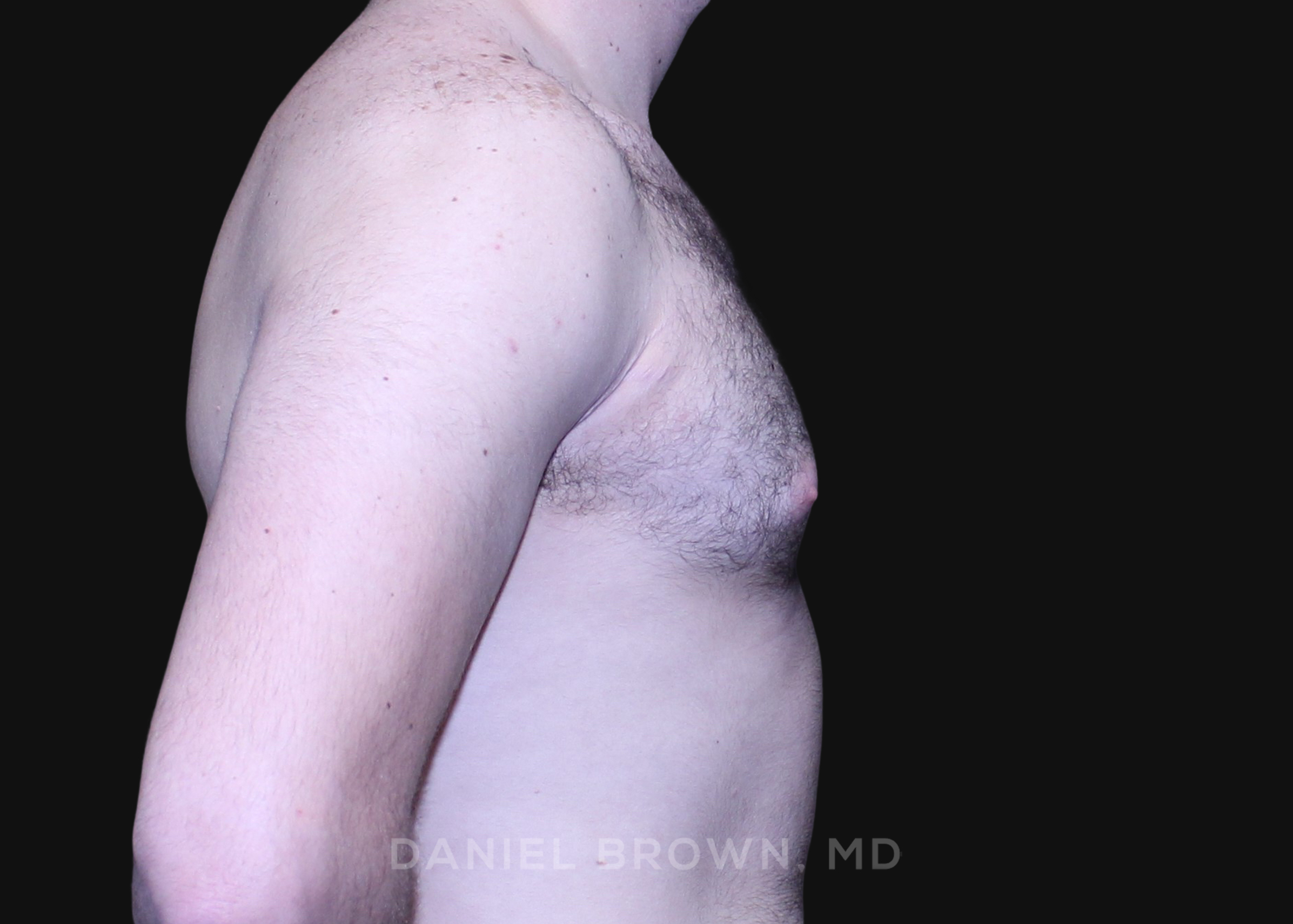 Male Breast Reduction Patient Photo - Case 2746 - before view-4