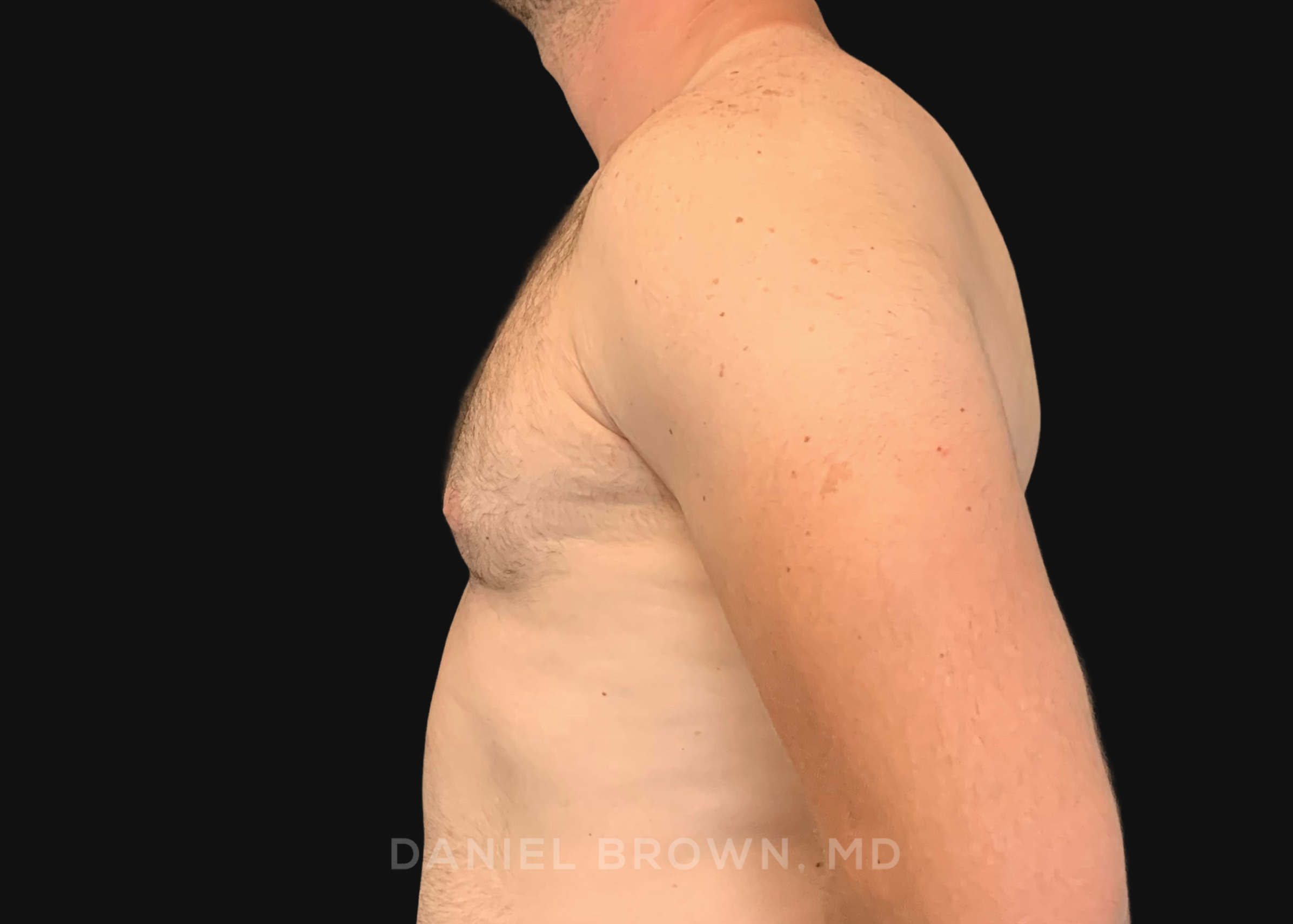 Male Breast Reduction Patient Photo - Case 2746 - after view-3