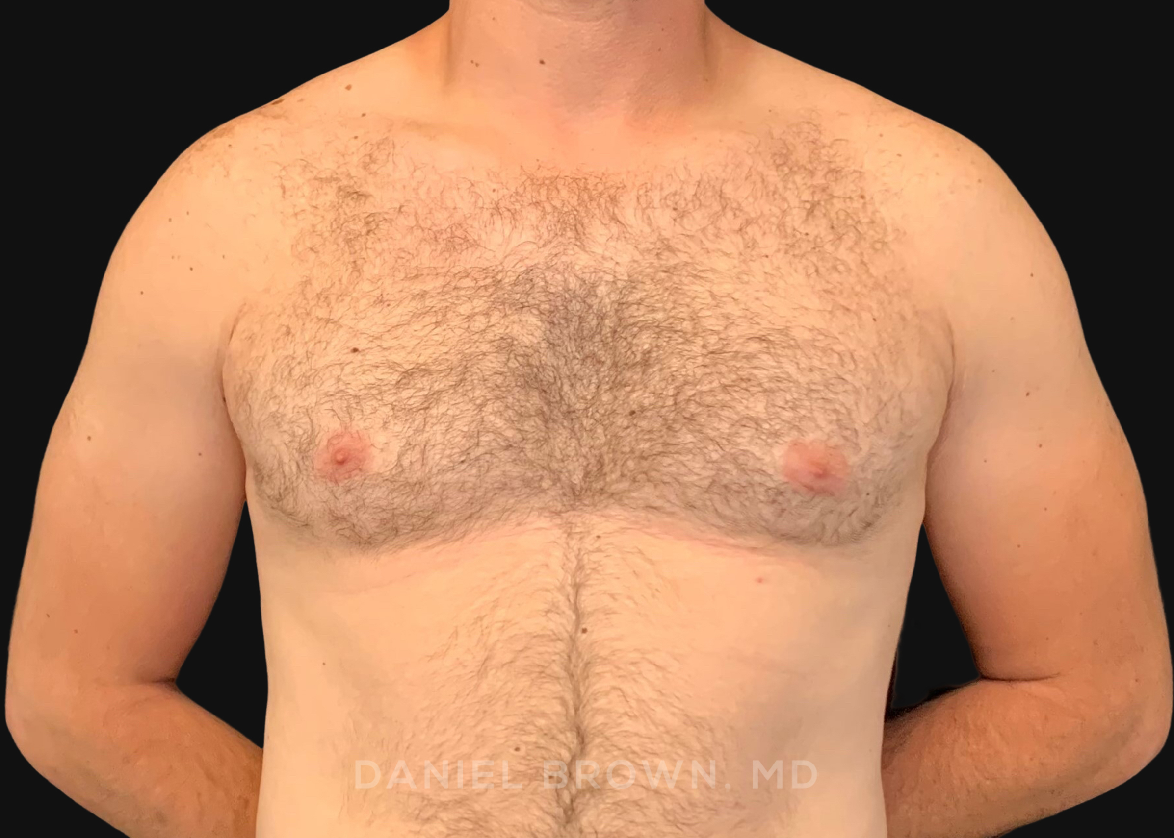 Male Breast Reduction Patient Photo - Case 2746 - after view