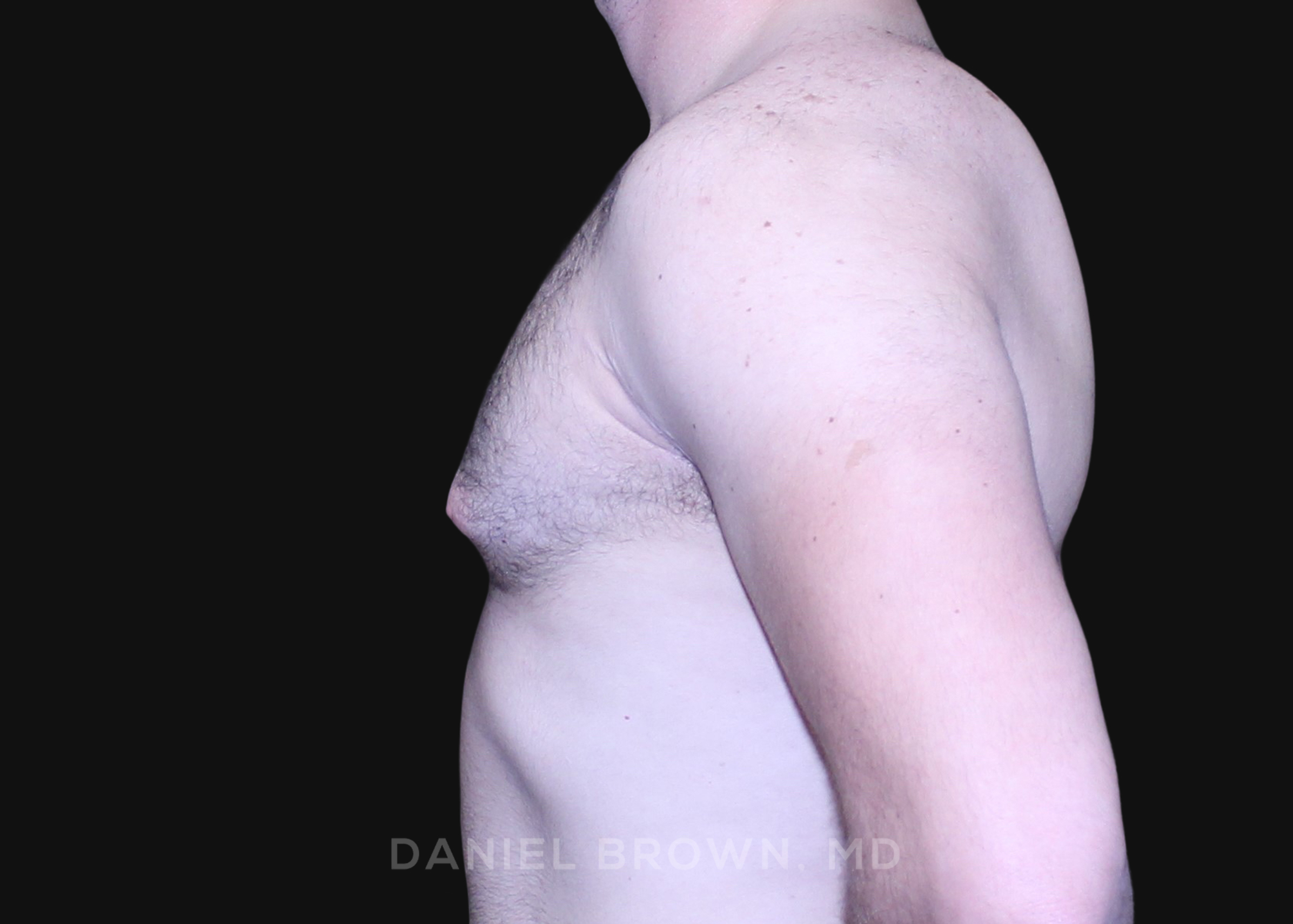 Male Breast Reduction Patient Photo - Case 2746 - before view-3