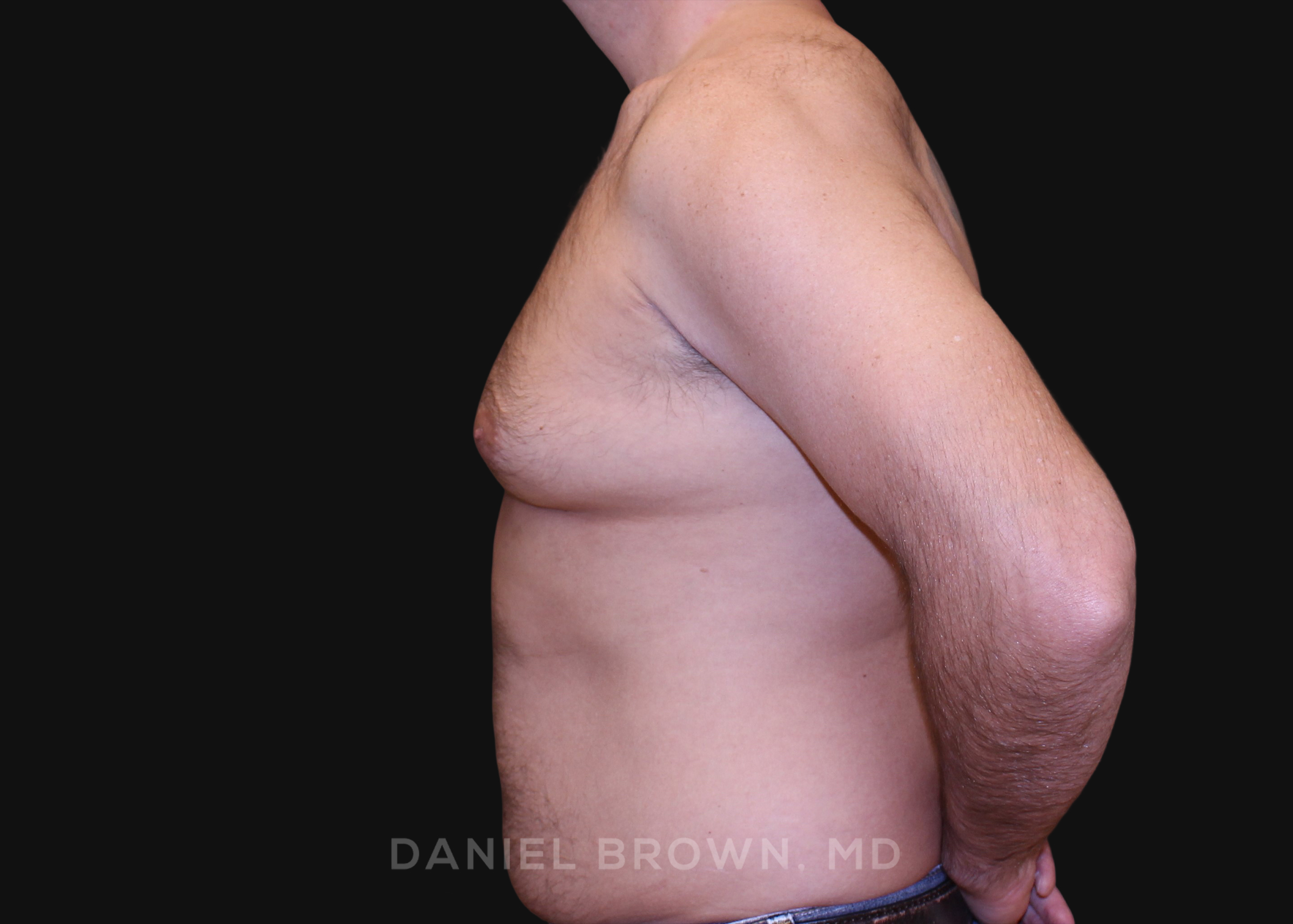 Male Breast Reduction Patient Photo - Case 2757 - before view-3