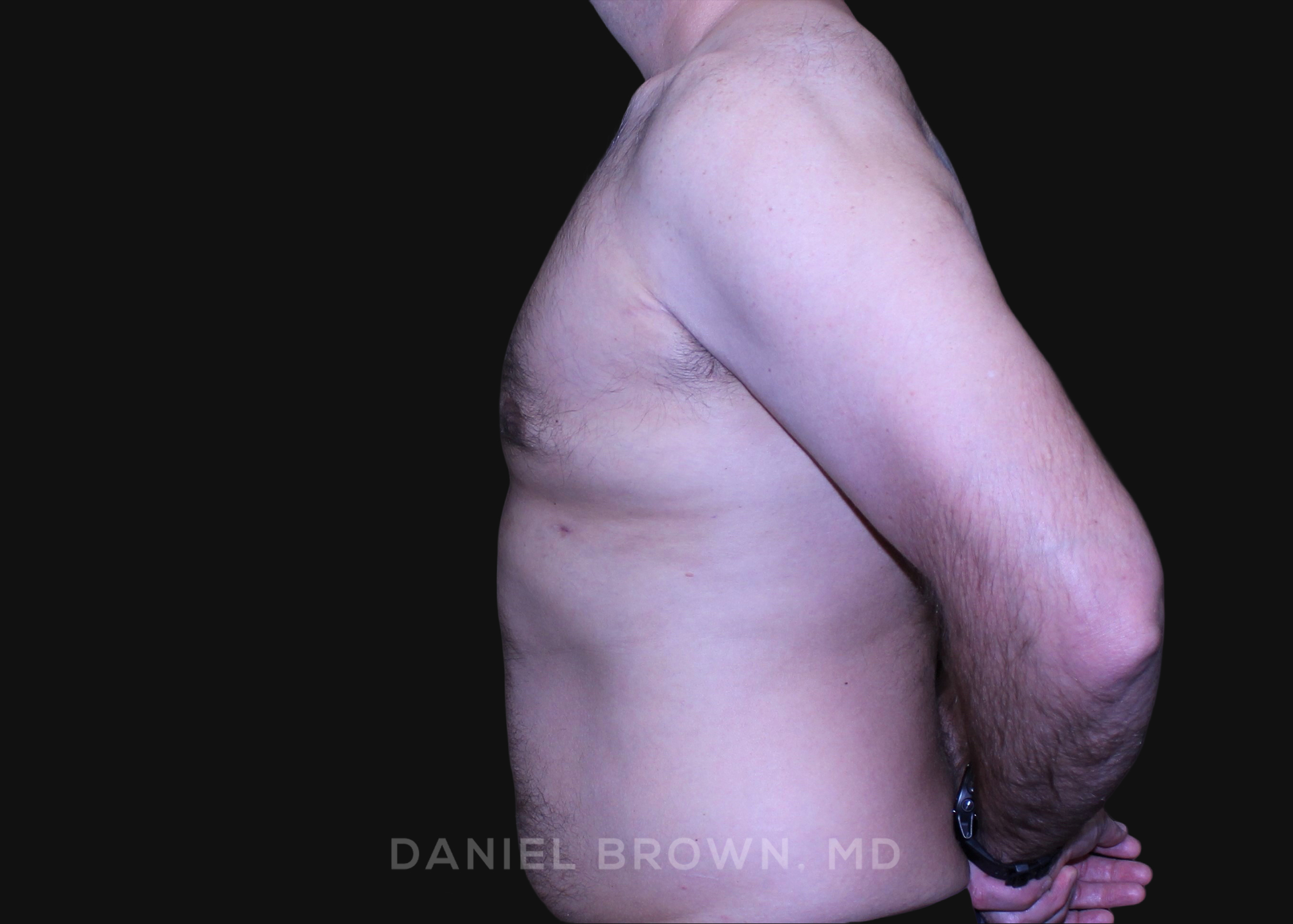 Male Breast Reduction Patient Photo - Case 2757 - after view