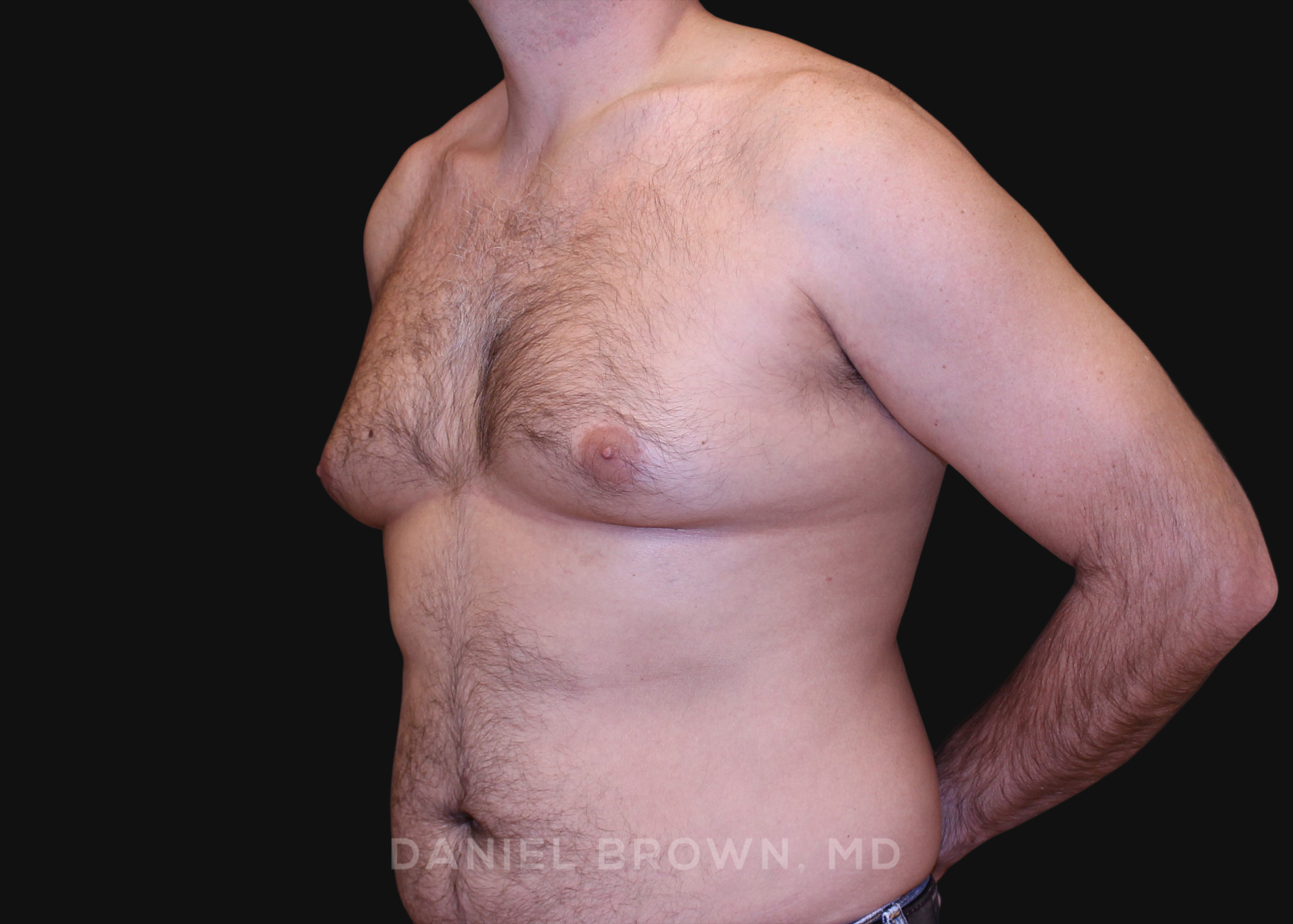 Male Breast Reduction Patient Photo - Case 2757 - before view-1