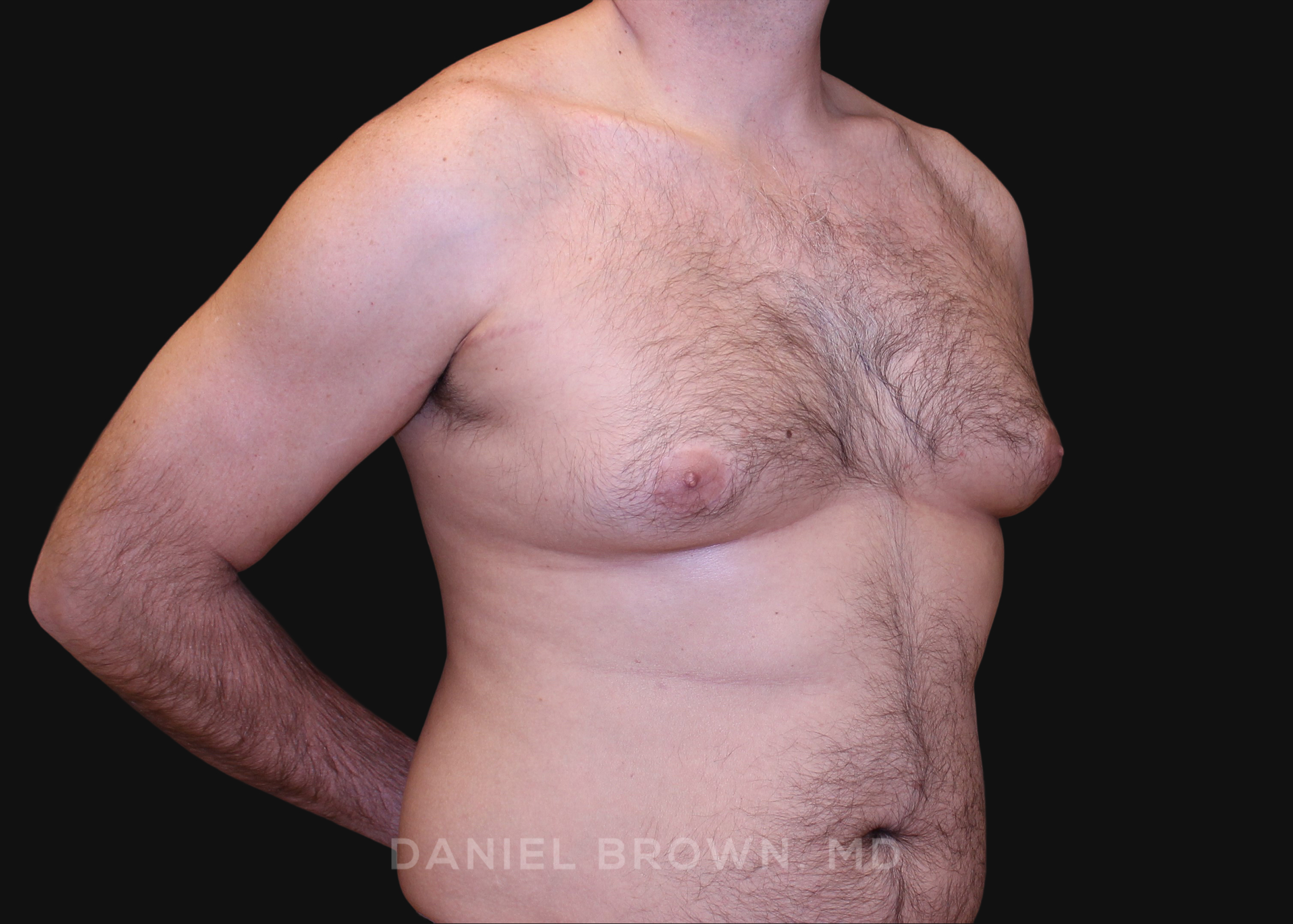 Male Breast Reduction Patient Photo - Case 2757 - before view-2