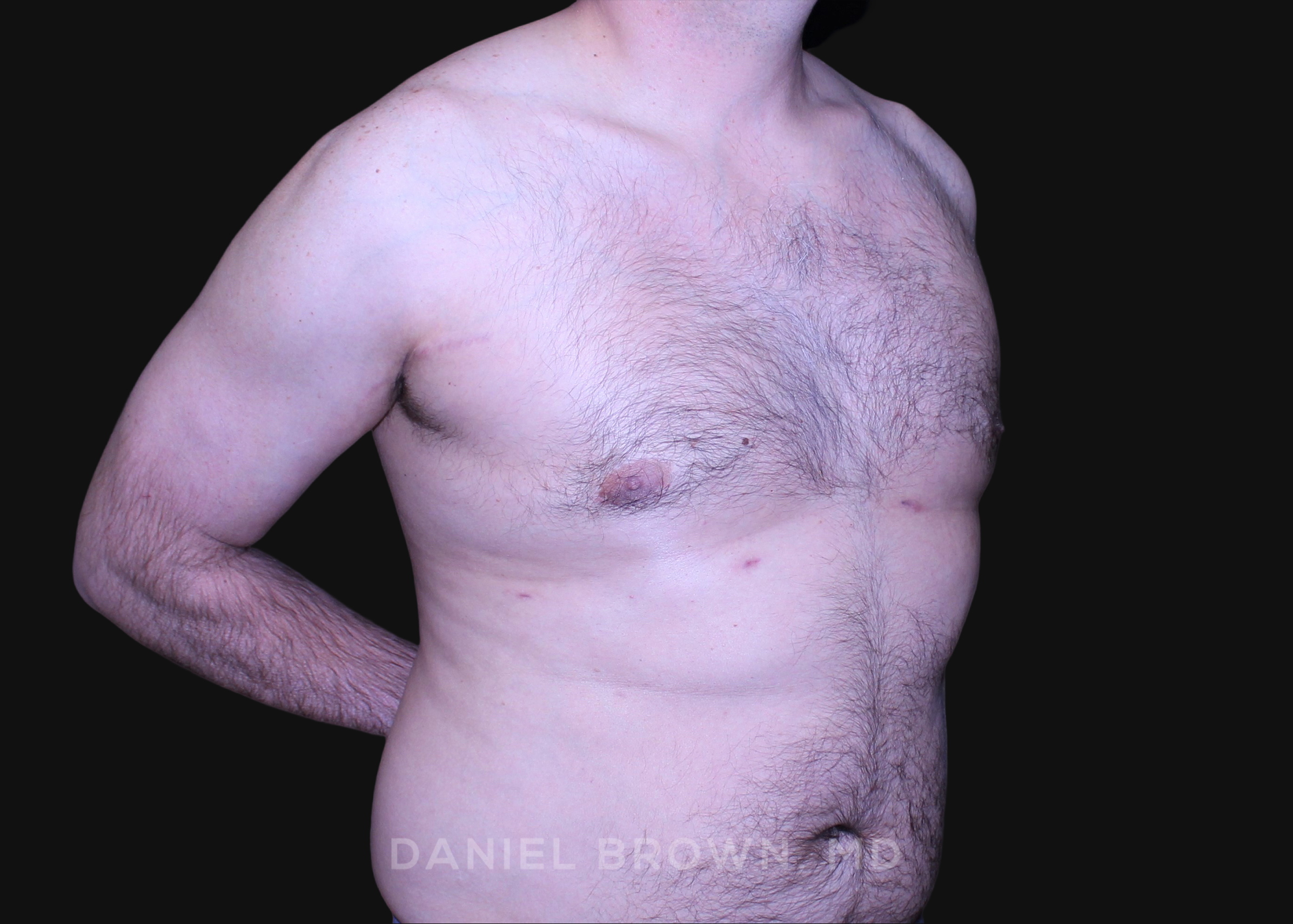 Male Breast Reduction Patient Photo - Case 2757 - after view-2
