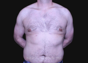 Male Breast Reduction - Case 2757 - After