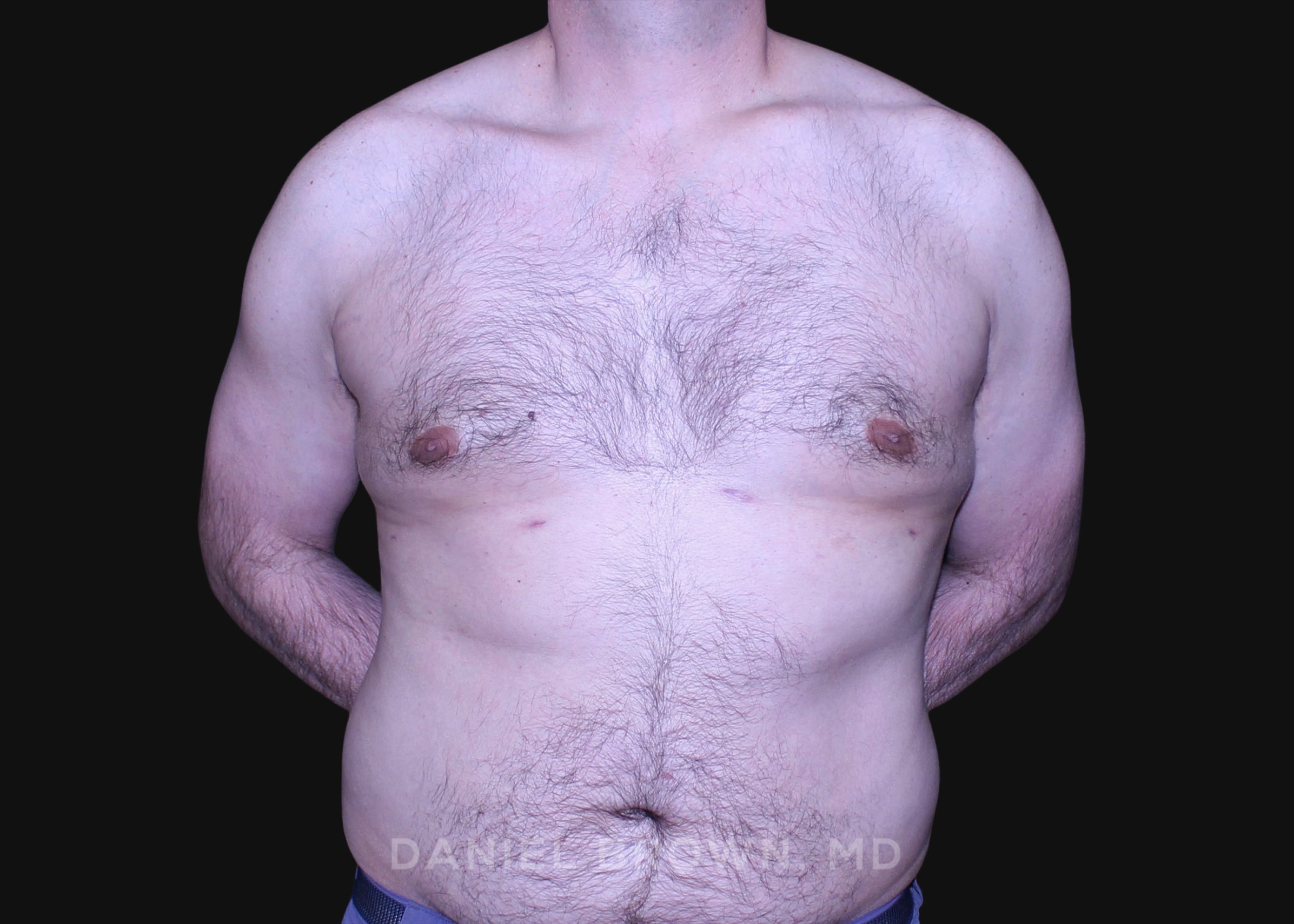 Male Breast Reduction Patient Photo - Case 2757 - after view