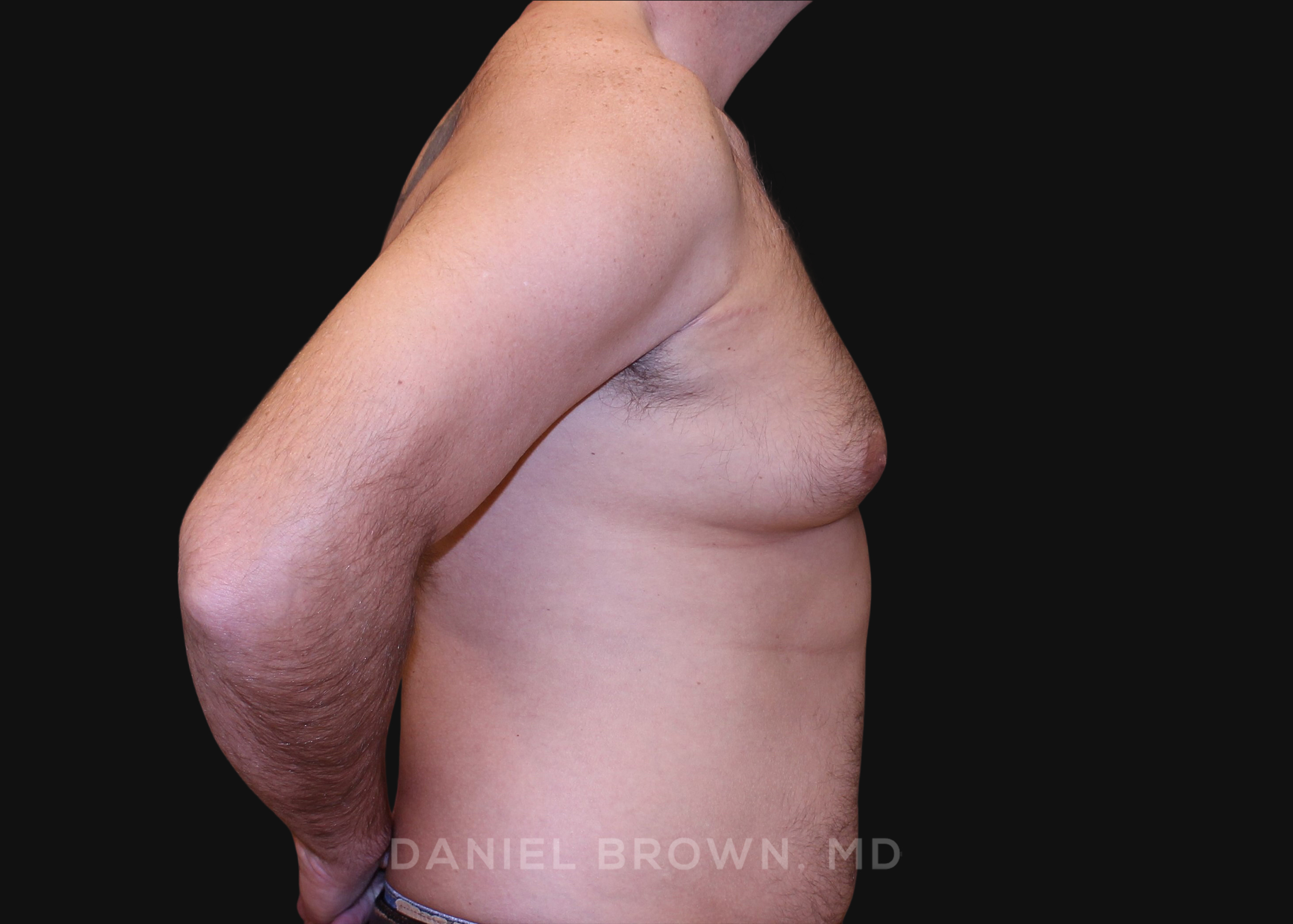 Male Breast Reduction Patient Photo - Case 2757 - before view-