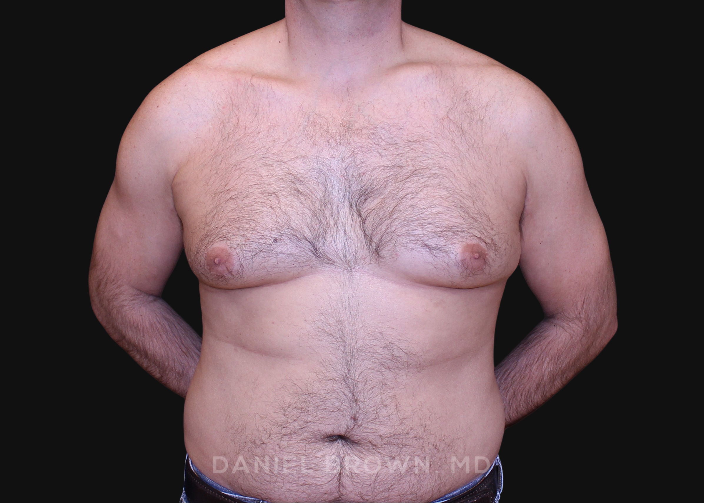 Male Breast Reduction Patient Photo - Case 2757 - before view-