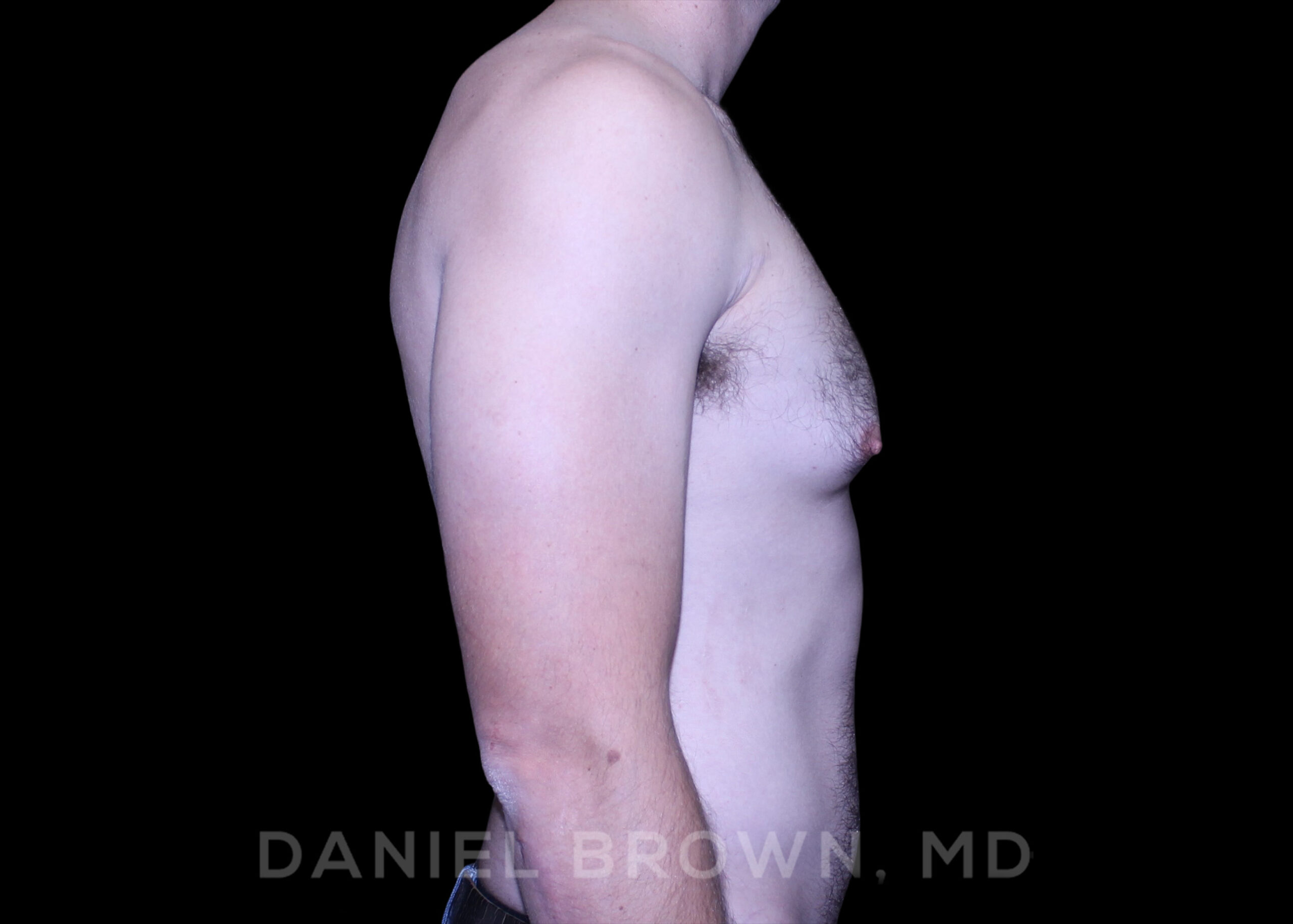 Male Breast Reduction Patient Photo - Case 2768 - before view-