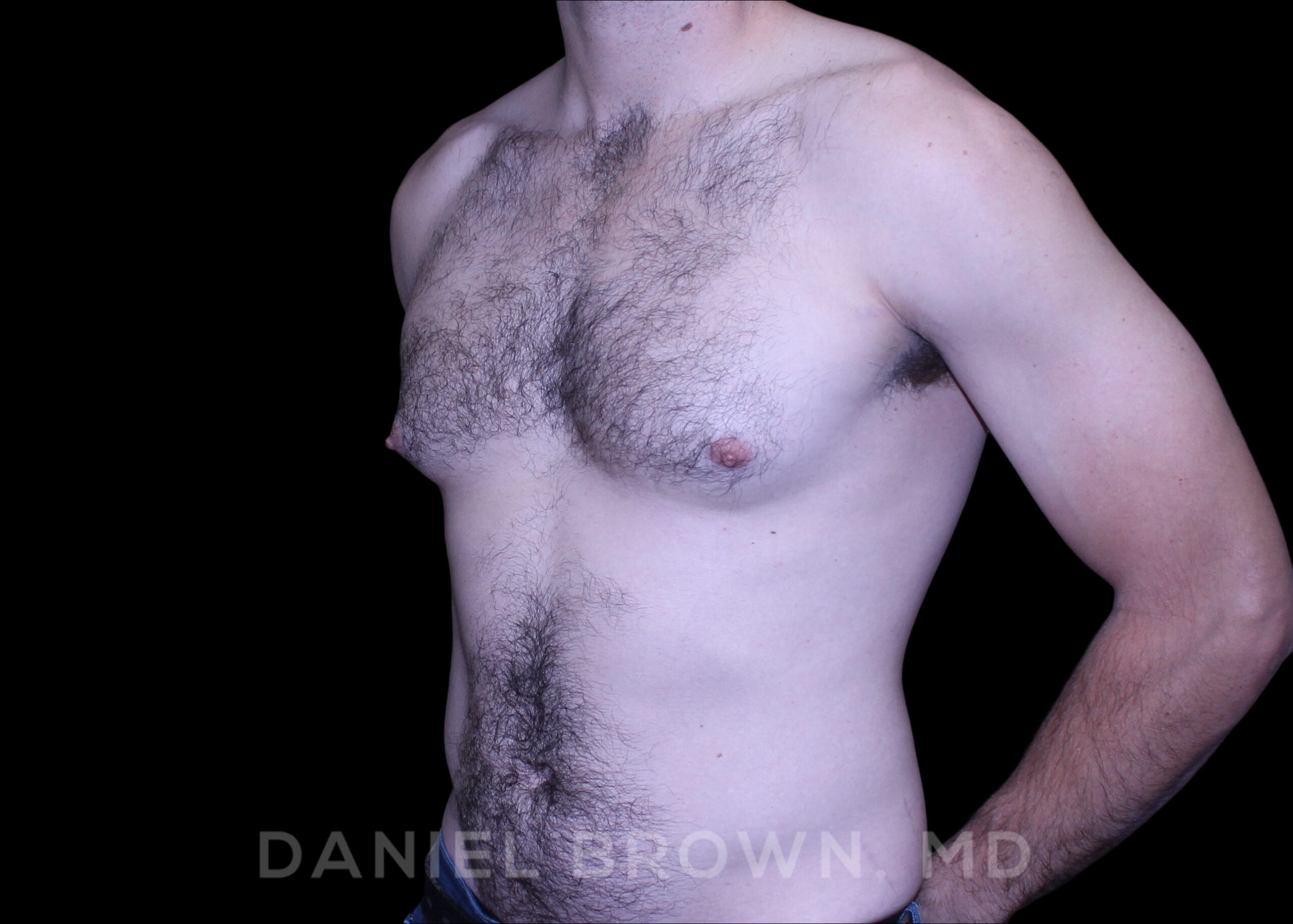 Male Breast Reduction Patient Photo - Case 2768 - after view-1