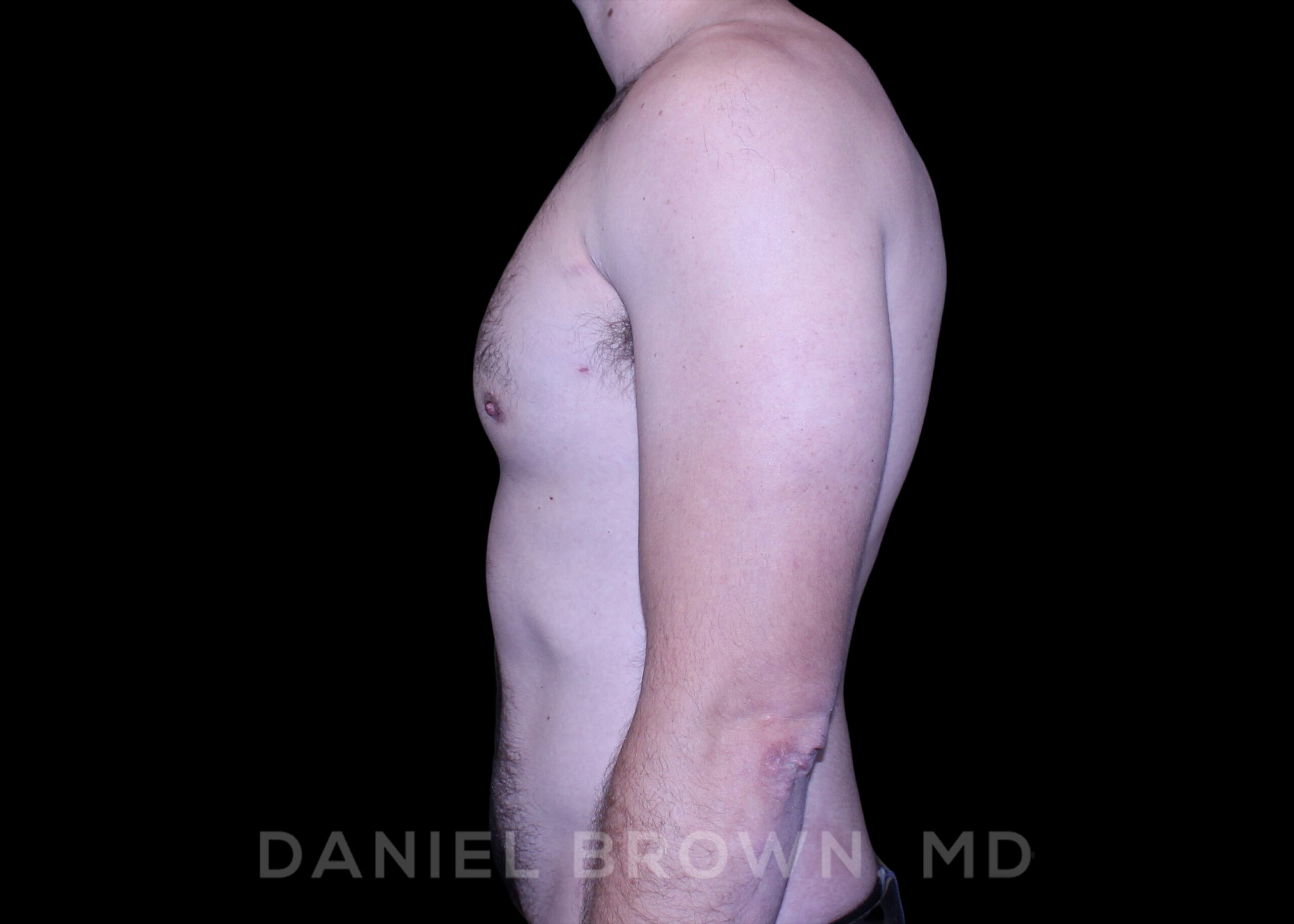 Male Breast Reduction Patient Photo - Case 2768 - after view-4