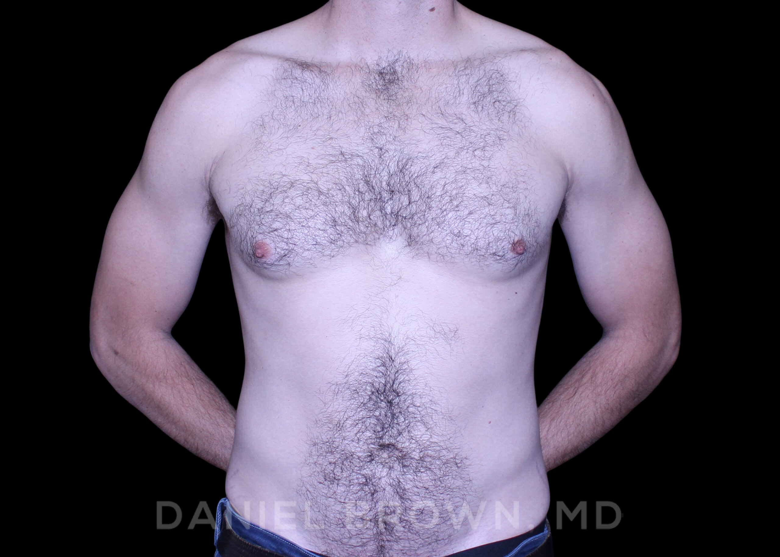 Male Breast Reduction Patient Photo - Case 2768 - before view-