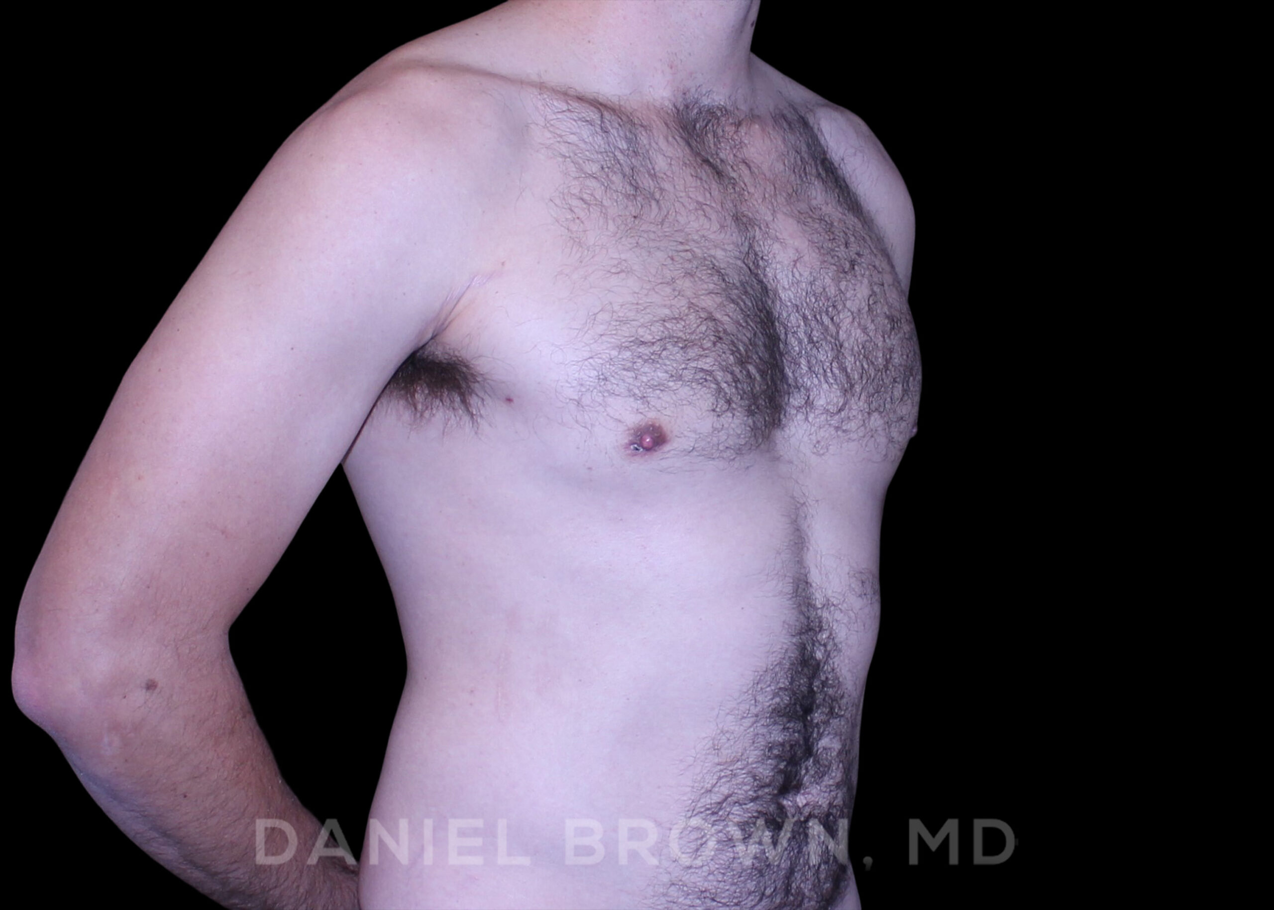 Male Breast Reduction Patient Photo - Case 2768 - after view-3