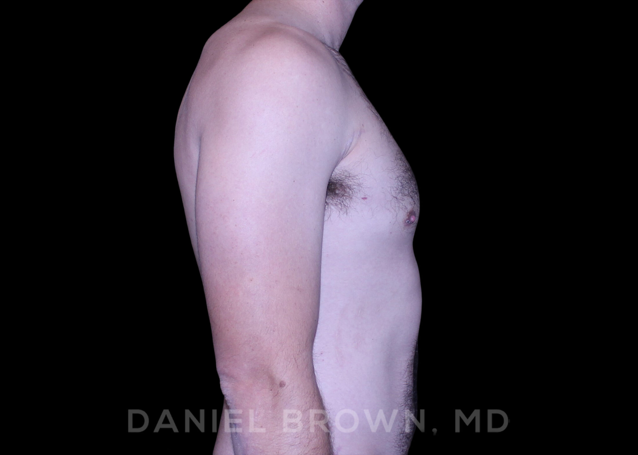 Male Breast Reduction Patient Photo - Case 2768 - after view-5