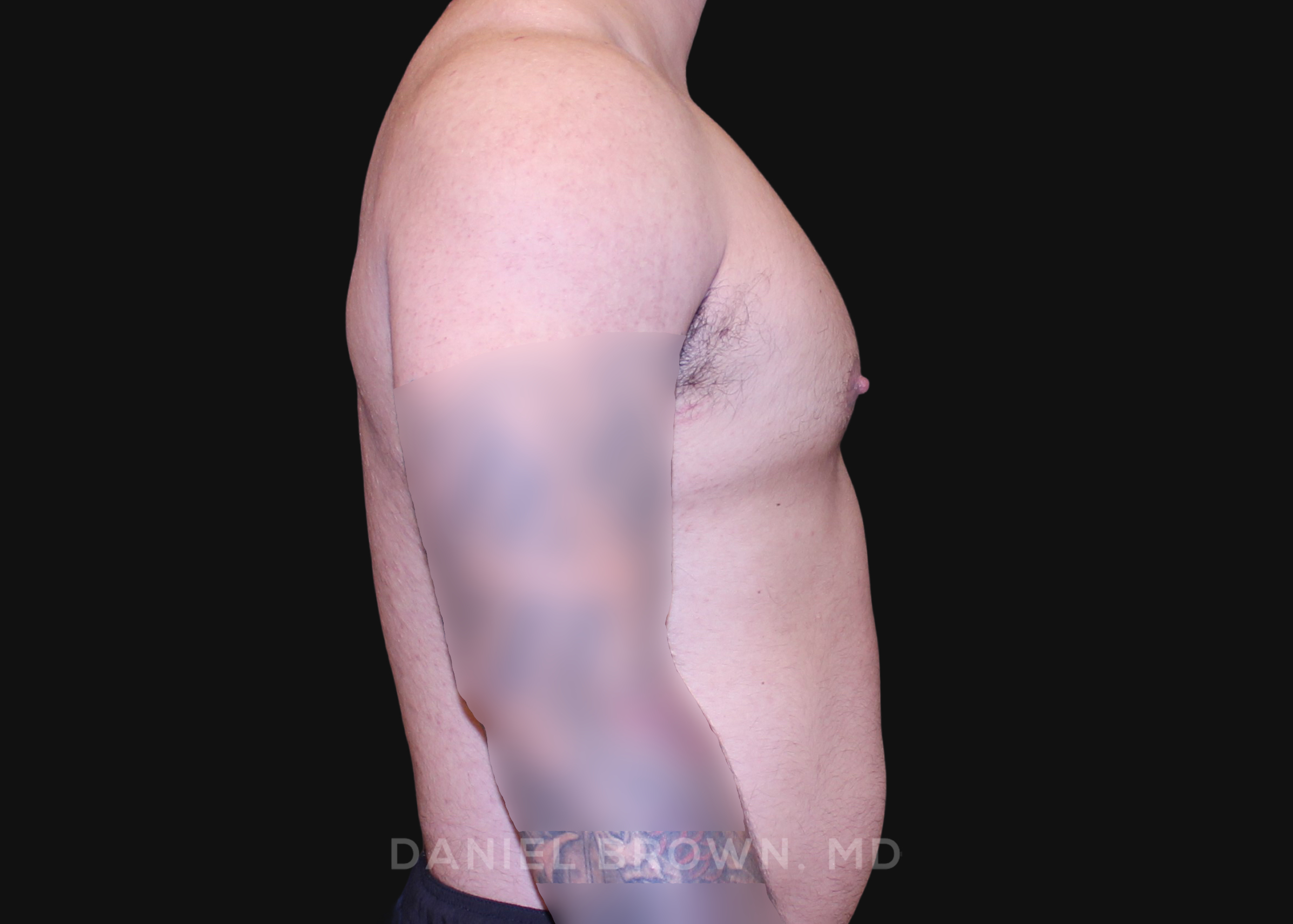 Male Breast Reduction Patient Photo - Case 2790 - after view