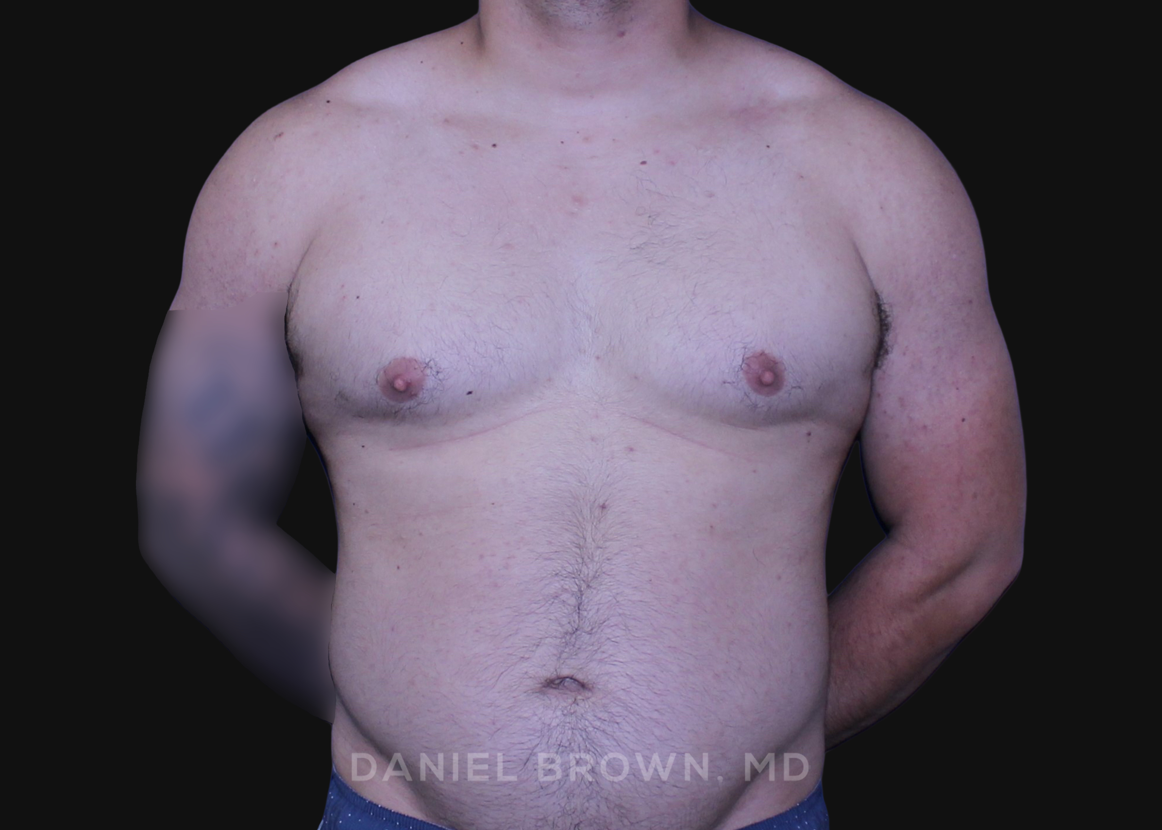 Male Breast Reduction Patient Photo - Case 2790 - before view-0