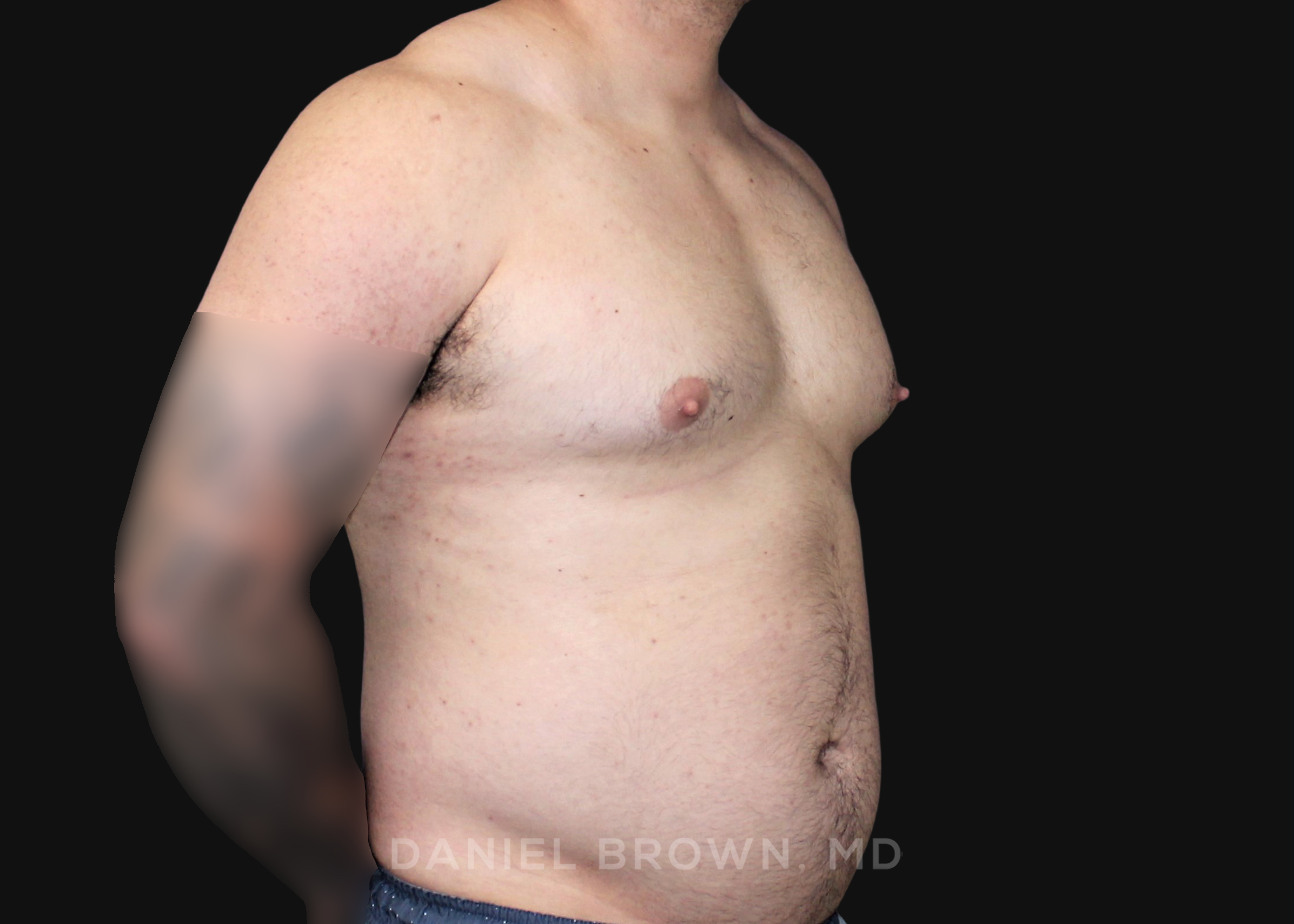 Male Breast Reduction Patient Photo - Case 2790 - before view-