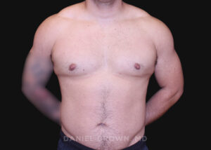Male Breast Reduction - Case 2790 - After