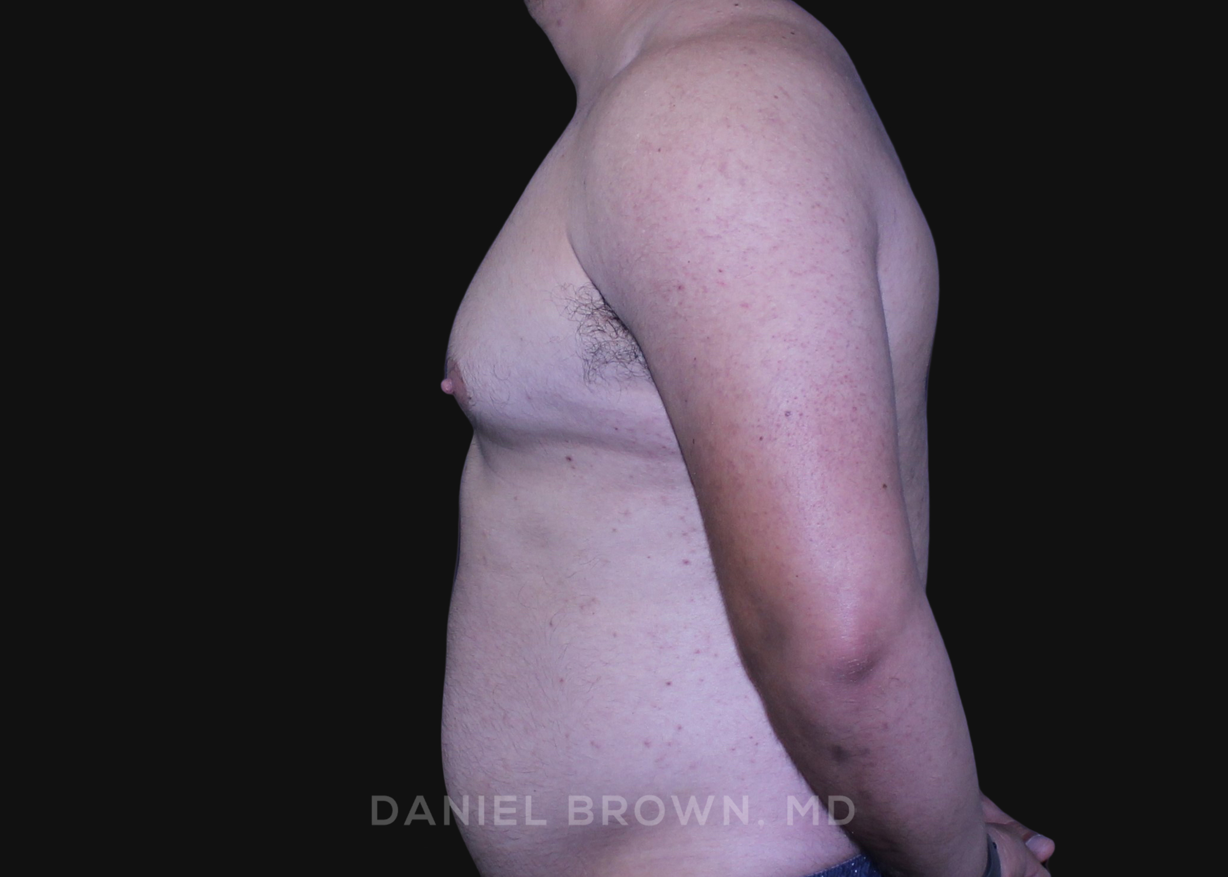 Male Breast Reduction Patient Photo - Case 2790 - before view-3