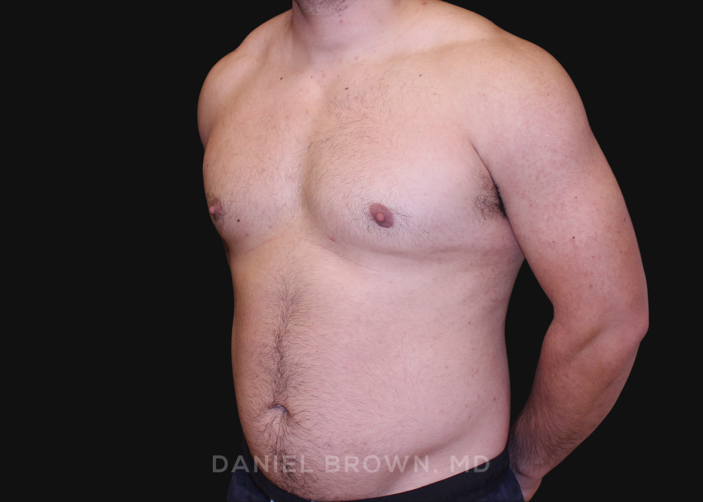 Male Breast Reduction Patient Photo - Case 2790 - after view