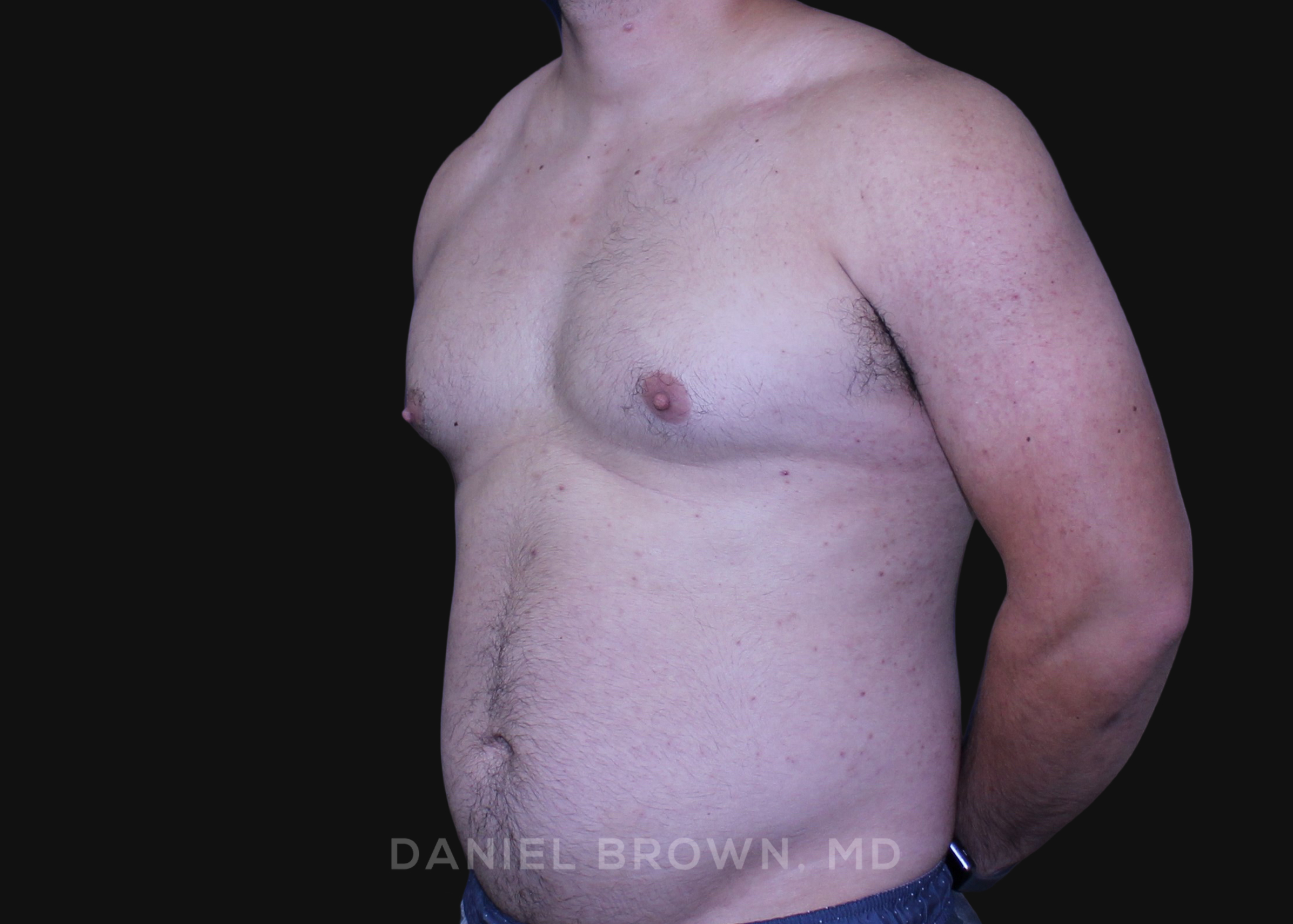Male Breast Reduction Patient Photo - Case 2790 - before view-1