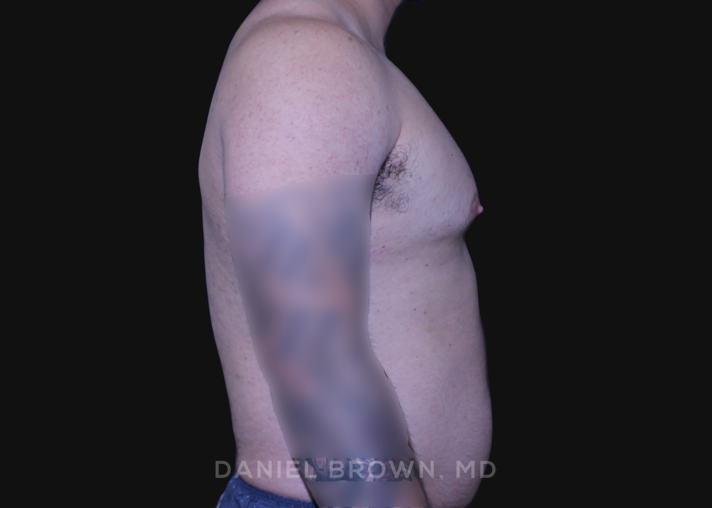 Male Breast Reduction Patient Photo - Case 2790 - before view-4