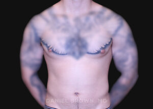 Male Breast Reduction - Case 2801 - Before