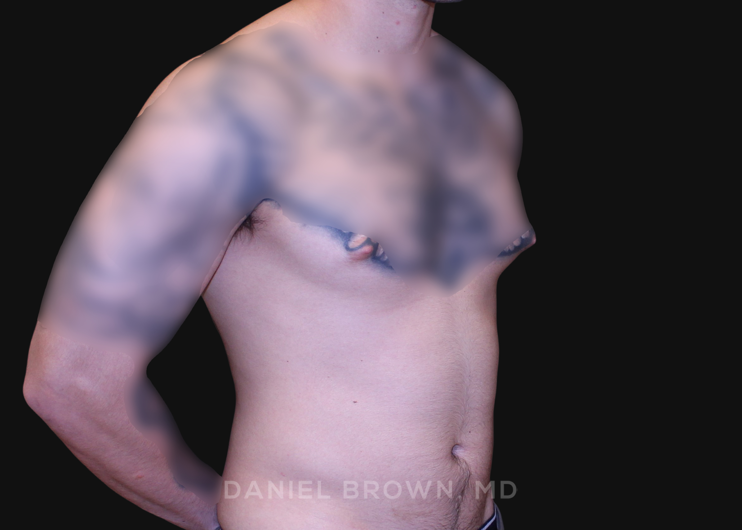 Male Breast Reduction Patient Photo - Case 2801 - before view-2