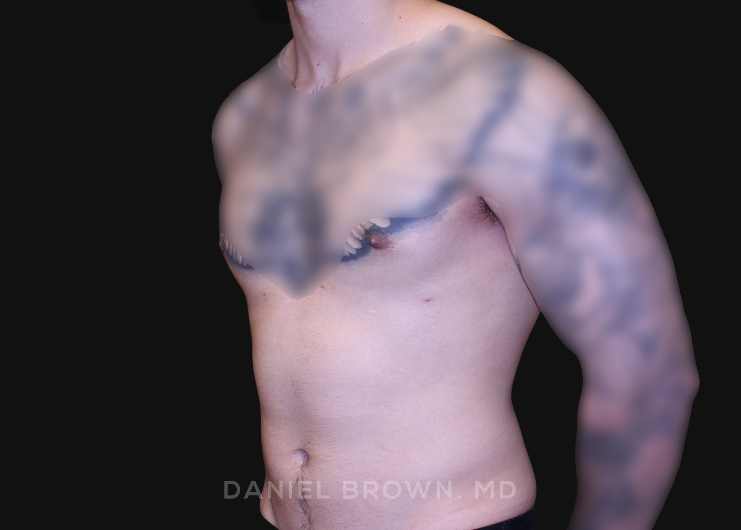 Male Breast Reduction Patient Photo - Case 2801 - after view