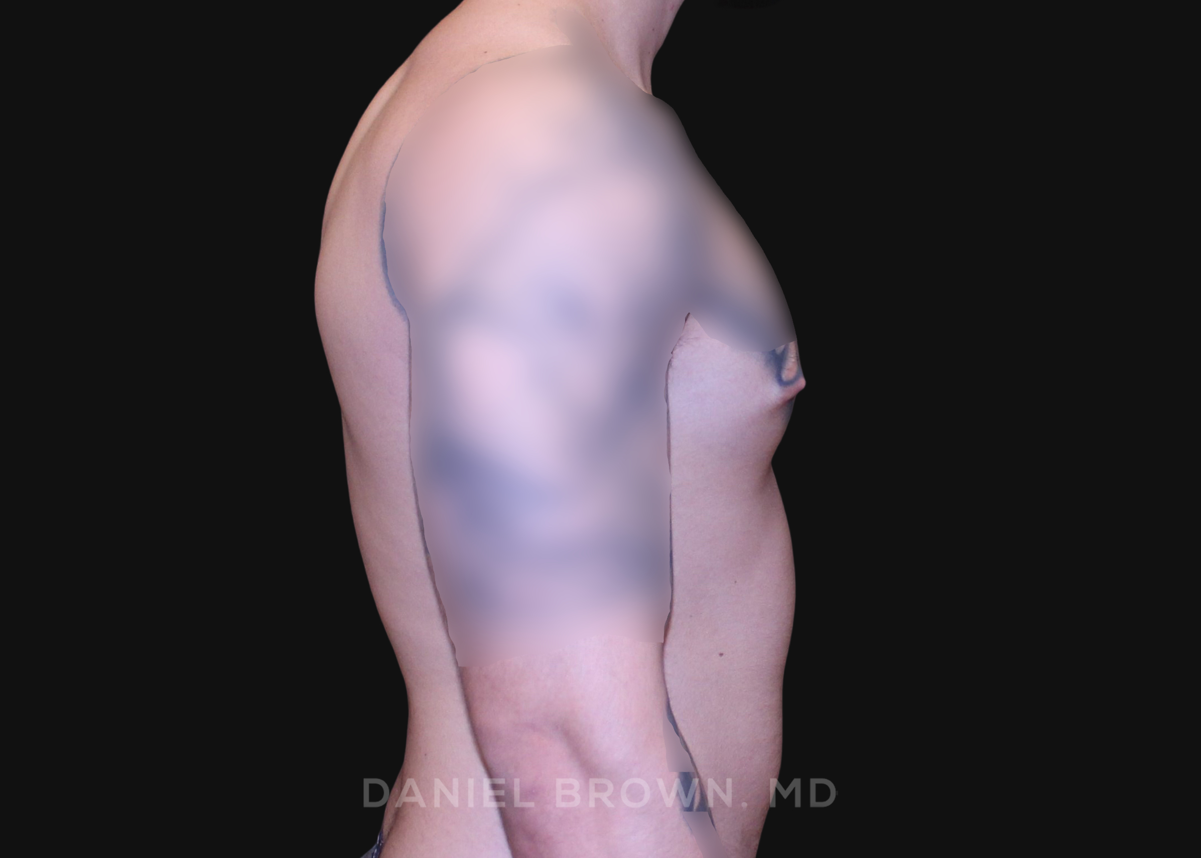 Male Breast Reduction Patient Photo - Case 2801 - before view-