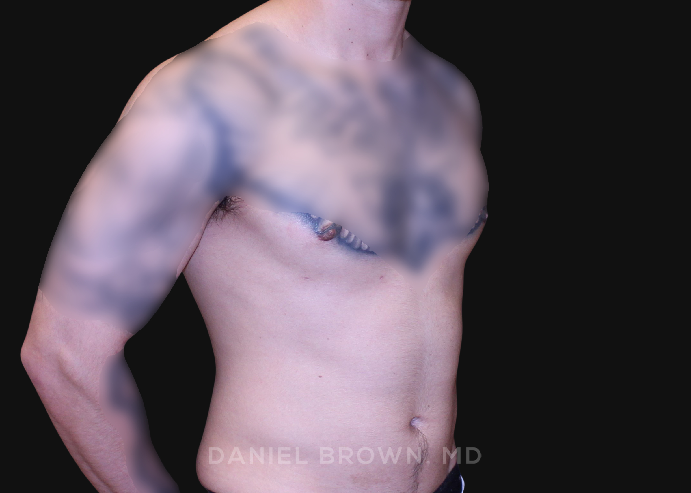 Male Breast Reduction Patient Photo - Case 2801 - after view