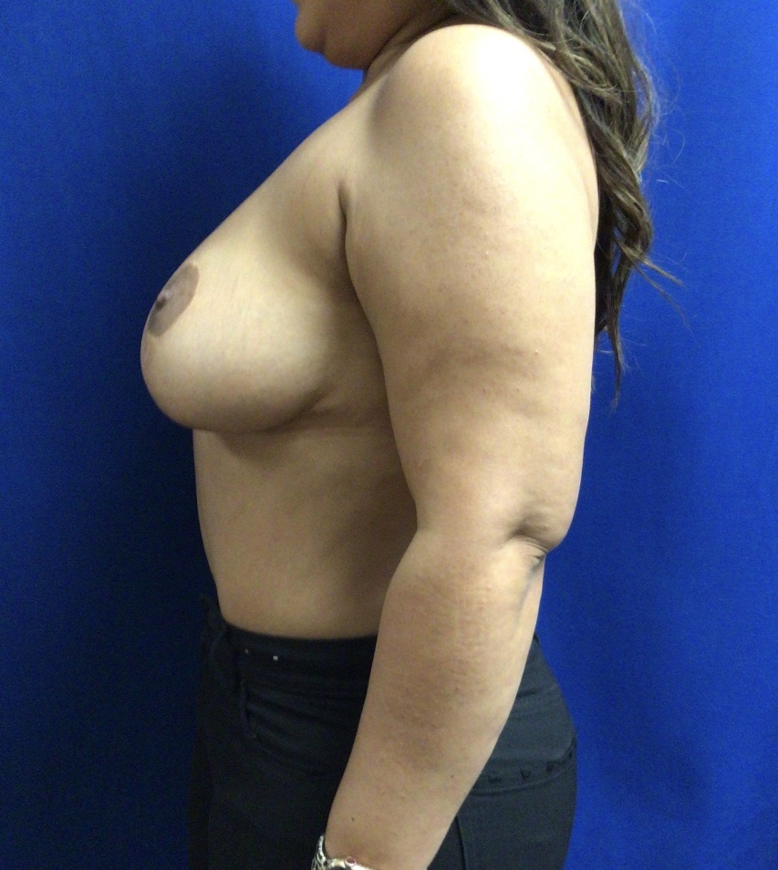 Breast Lift Patient Photo - Case 3636 - before view-1