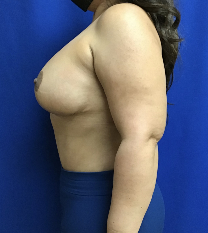 Breast Lift Patient Photo - Case 3636 - after view