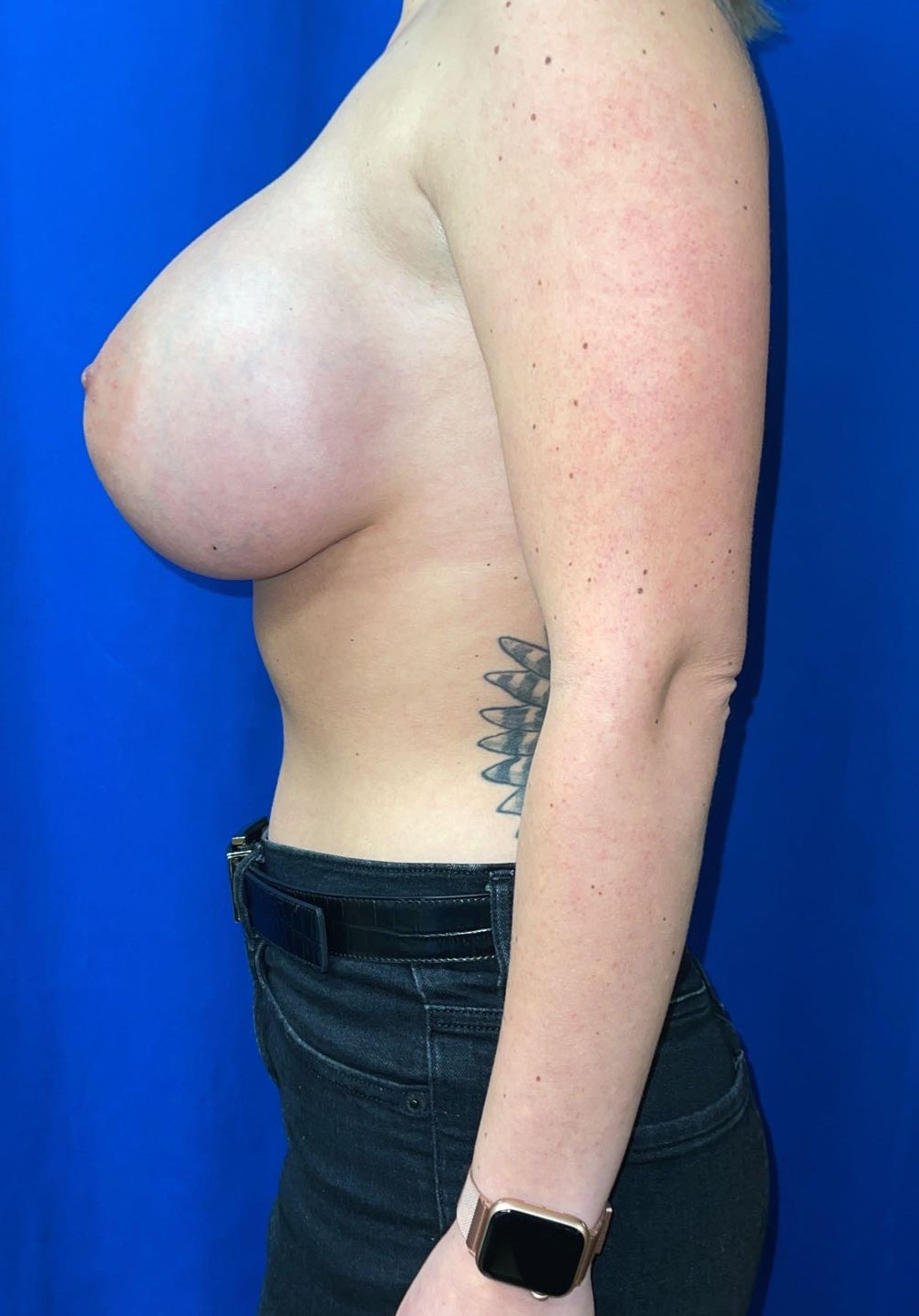 Breast Augmentation Patient Photo - Case 3643 - after view