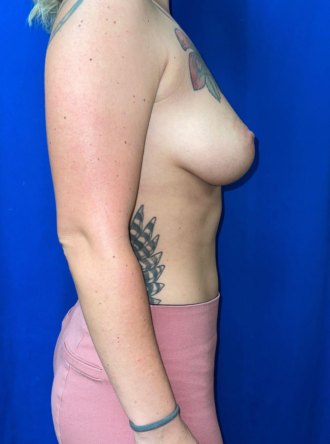 Breast Augmentation Patient Photo - Case 3643 - before view-