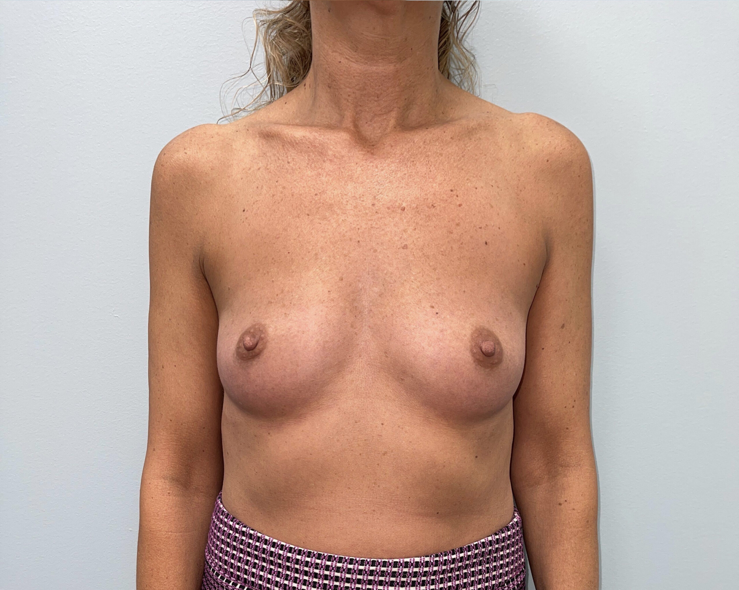 Breast Augmentation Patient Photo - Case 3650 - before view-0