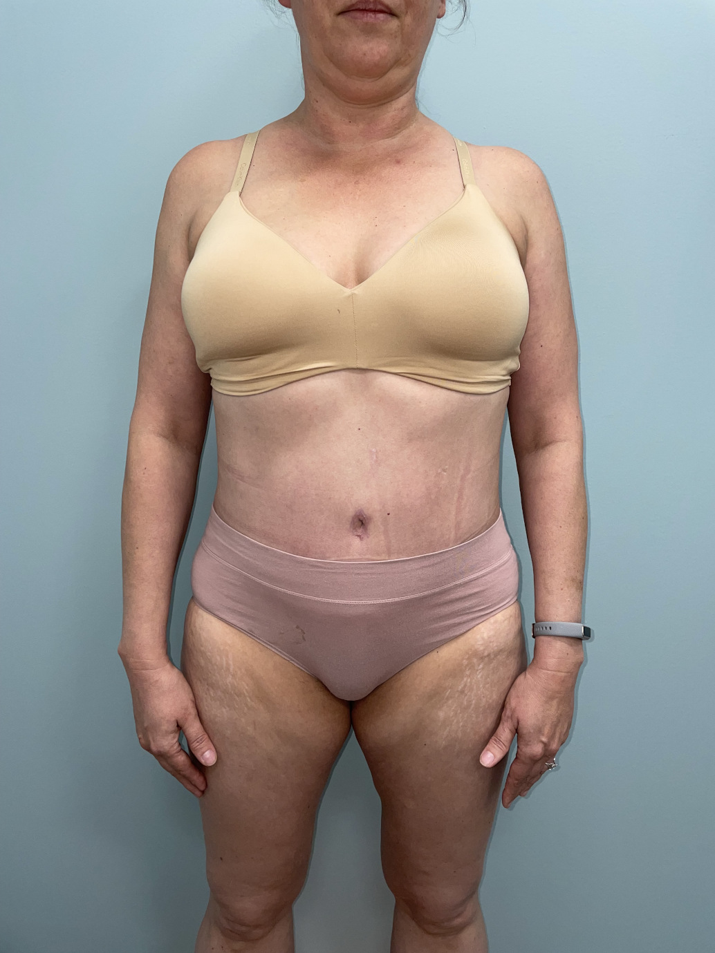 Tummy Tuck Patient Photo - Case 3655 - after view