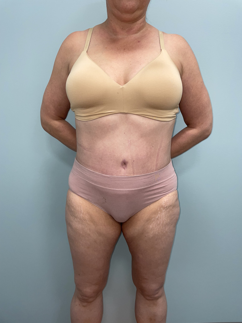 Tummy Tuck Patient Photo - Case 3655 - after view-5