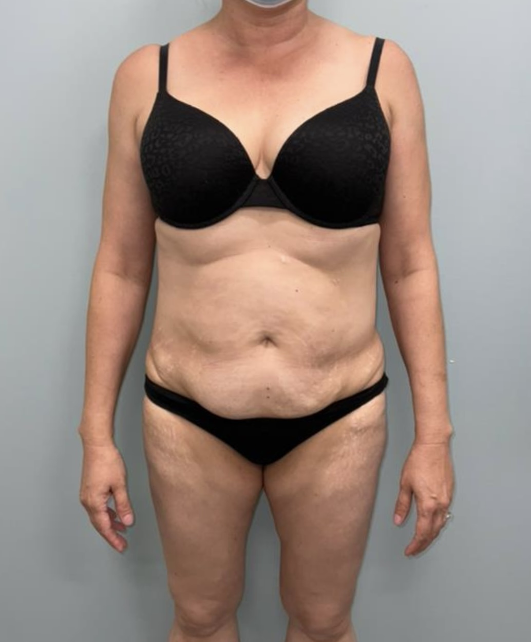 Tummy Tuck Patient Photo - Case 3655 - before view-0