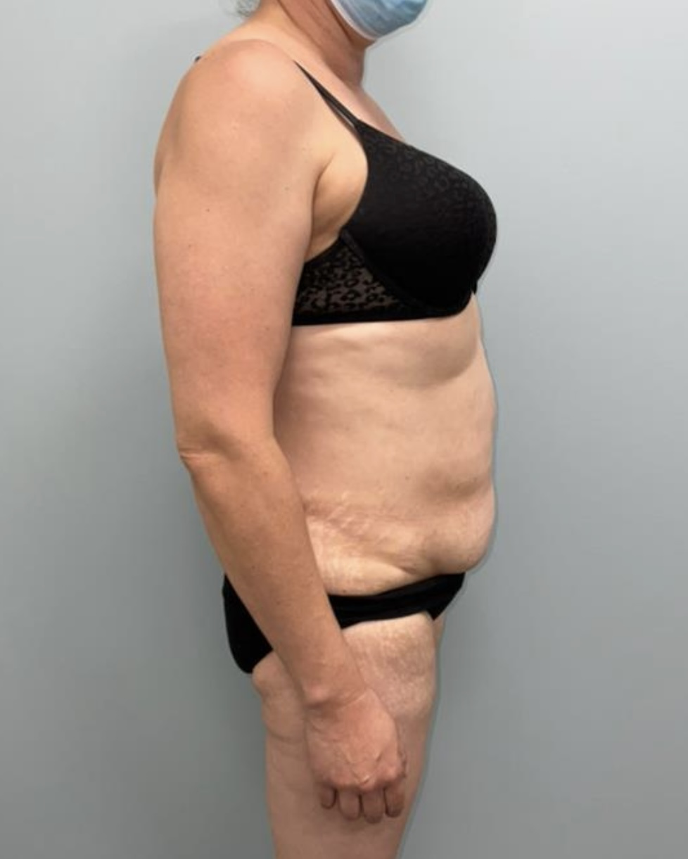 Tummy Tuck Patient Photo - Case 3655 - before view-4