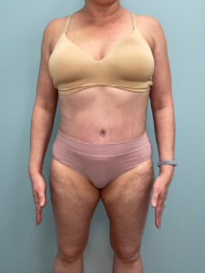 Tummy Tuck - Case 3655 - After
