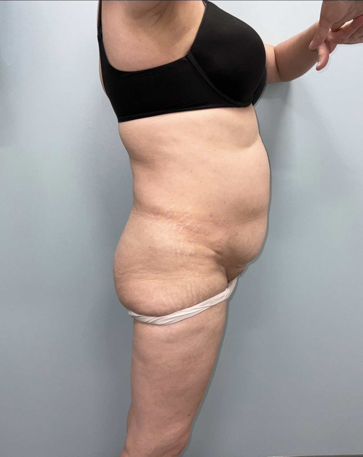 Tummy Tuck Patient Photo - Case 3655 - before view-1
