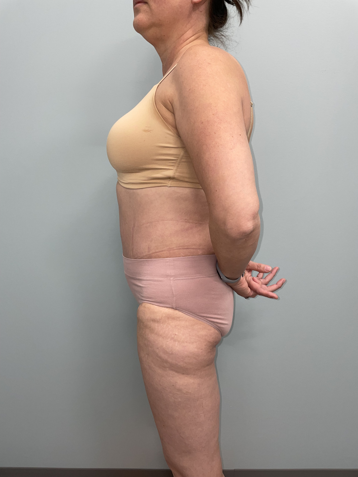 Tummy Tuck Patient Photo - Case 3655 - after view