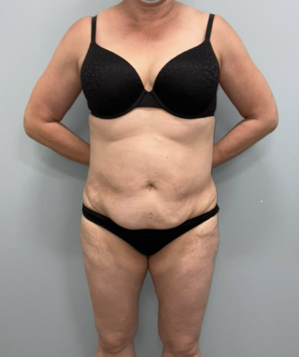Tummy Tuck Patient Photo - Case 3655 - before view-5