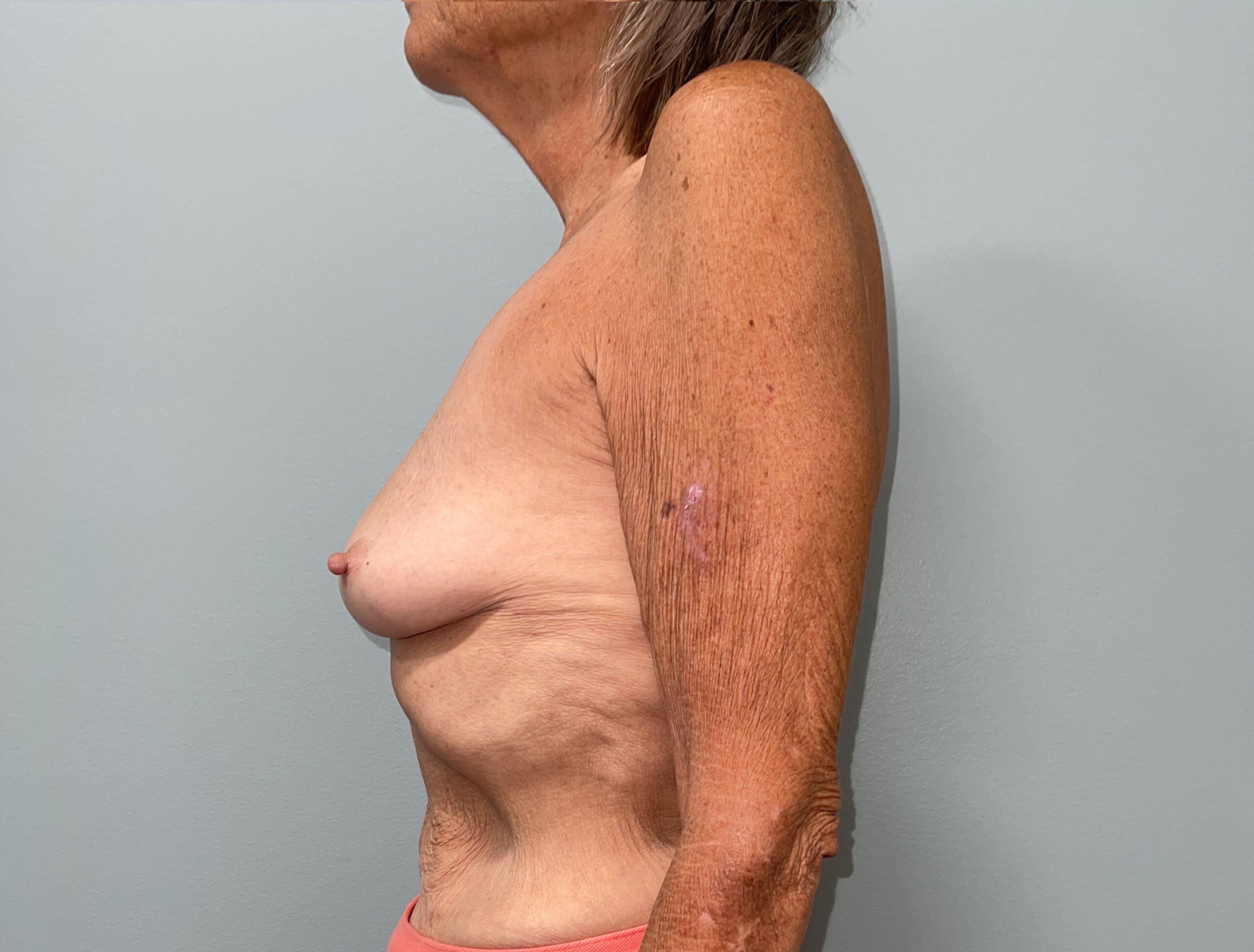 Mommy Makeover Patient Photo - Case 3668 - before view-