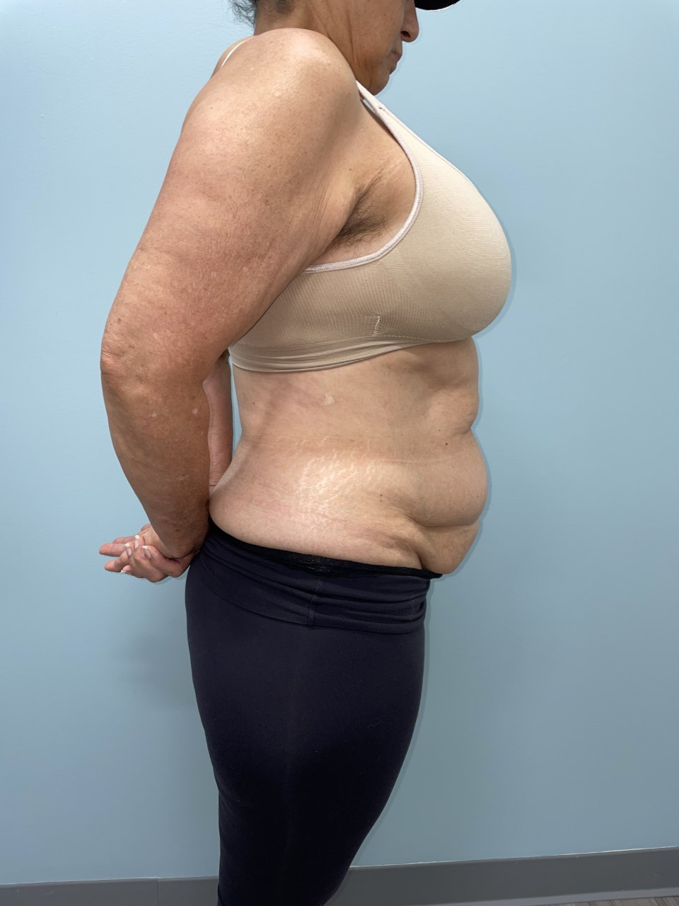 Tummy Tuck Patient Photo - Case 3686 - before view-5