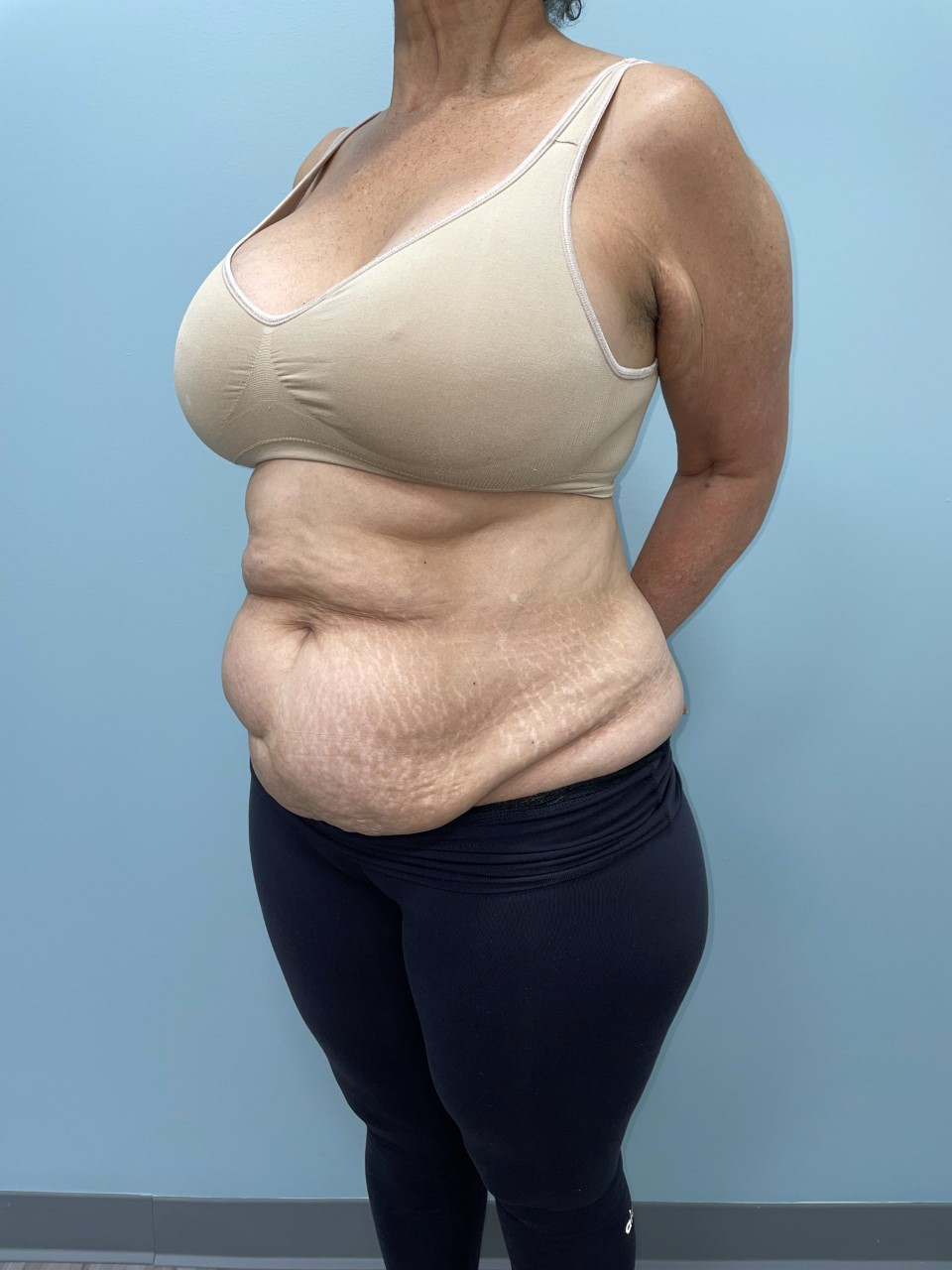 Tummy Tuck Patient Photo - Case 3686 - before view-1